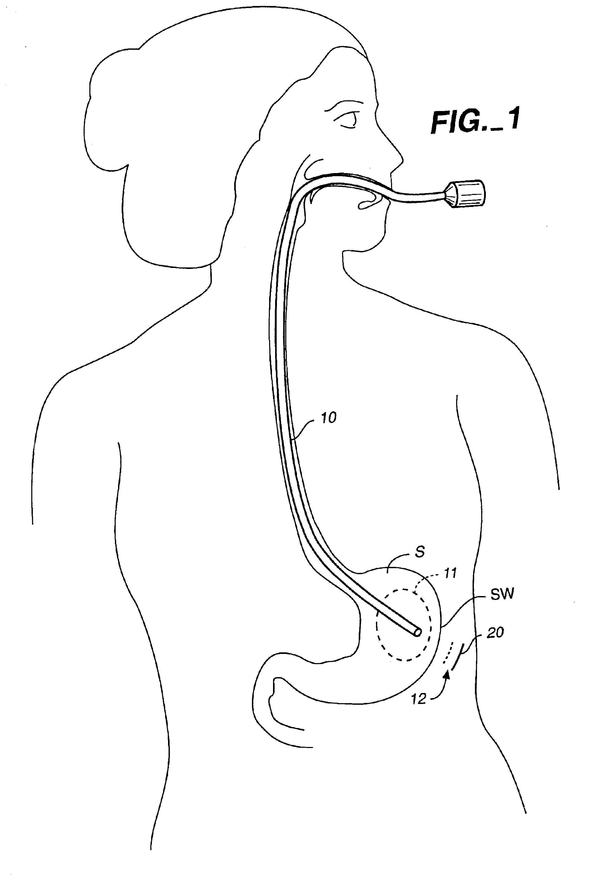 Method and device for use in minimally invasive placement of space-occupying intragastric devices