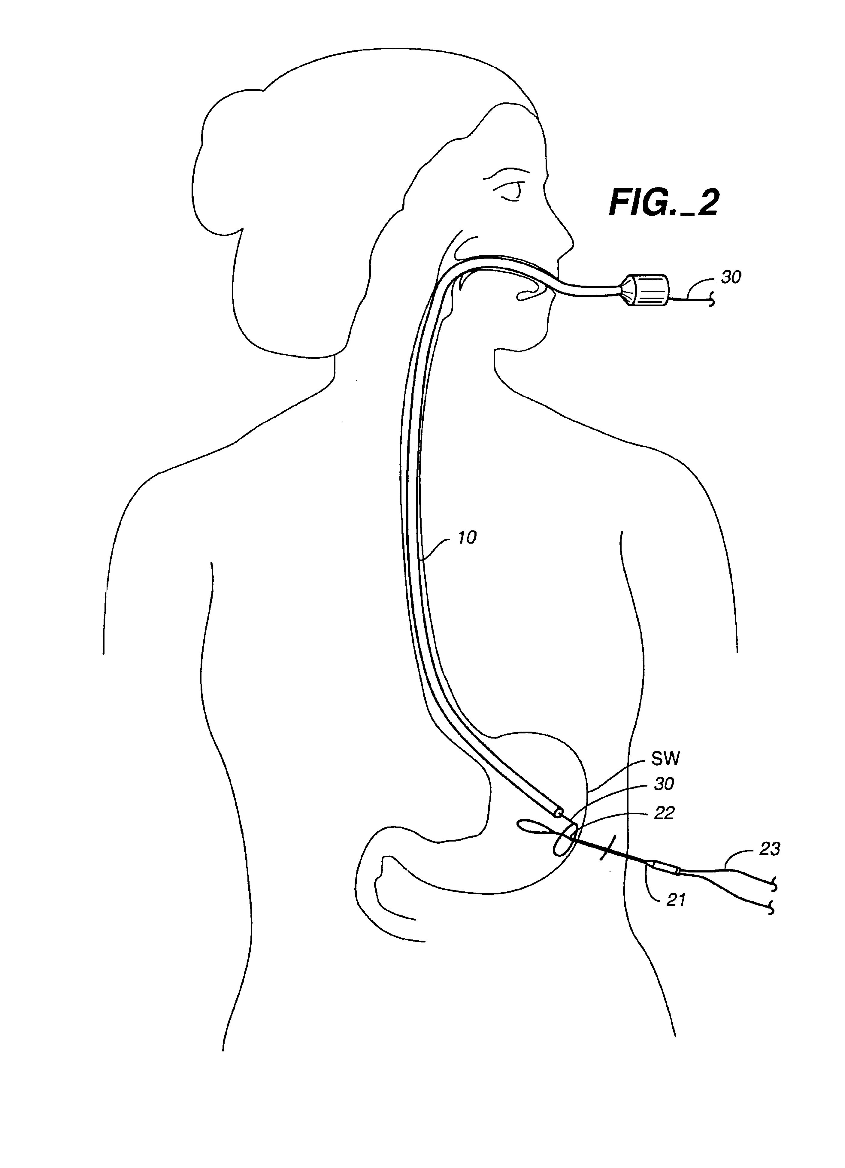 Method and device for use in minimally invasive placement of space-occupying intragastric devices