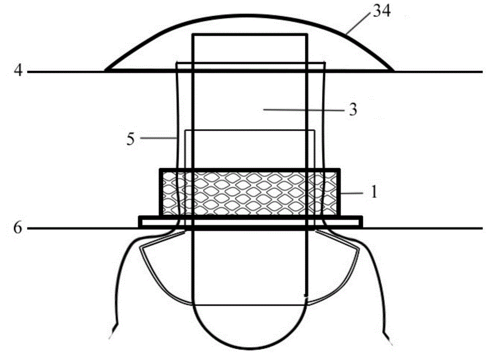 Bag-free controllable abdomen ostomy device