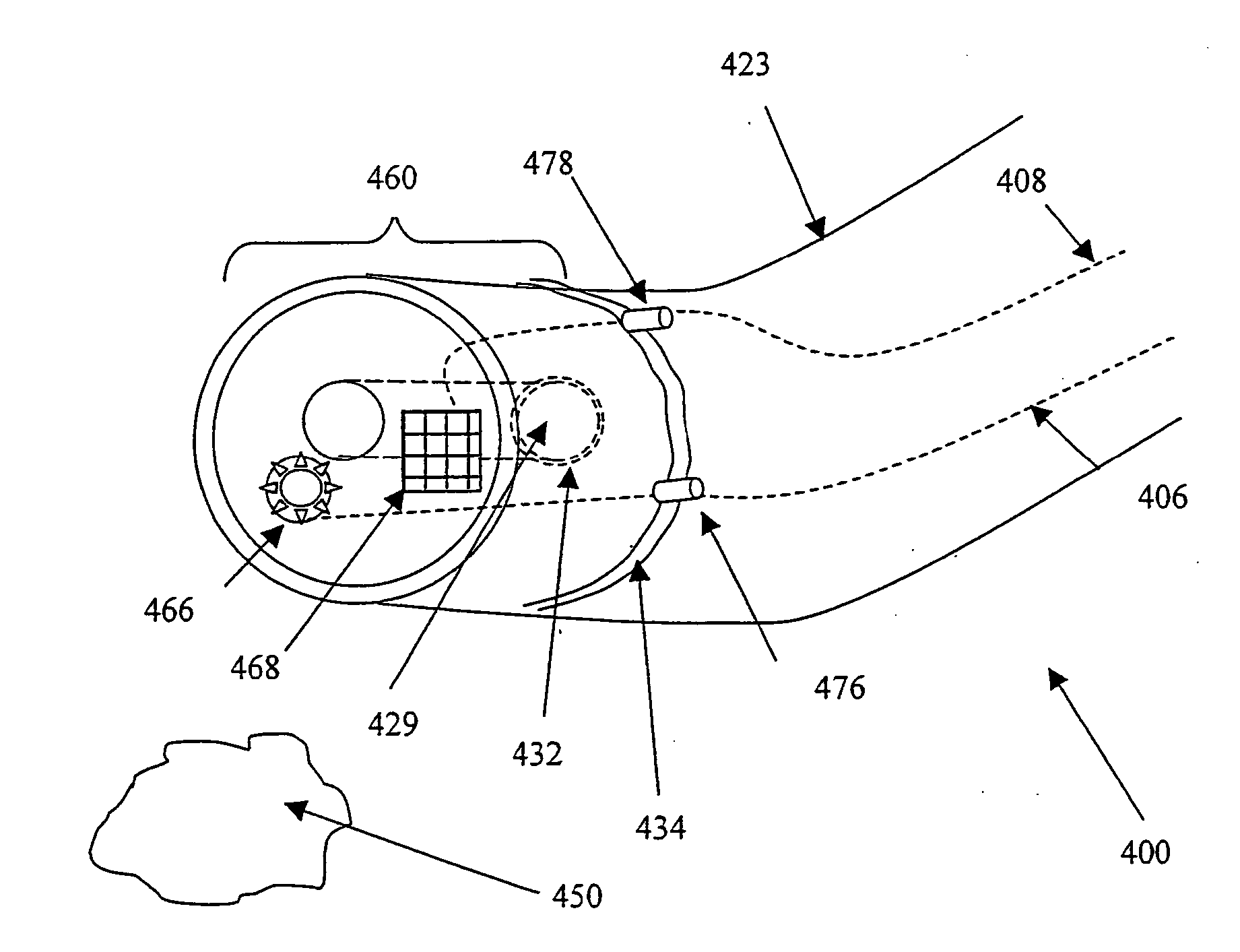 Endoscopy device with removable tip