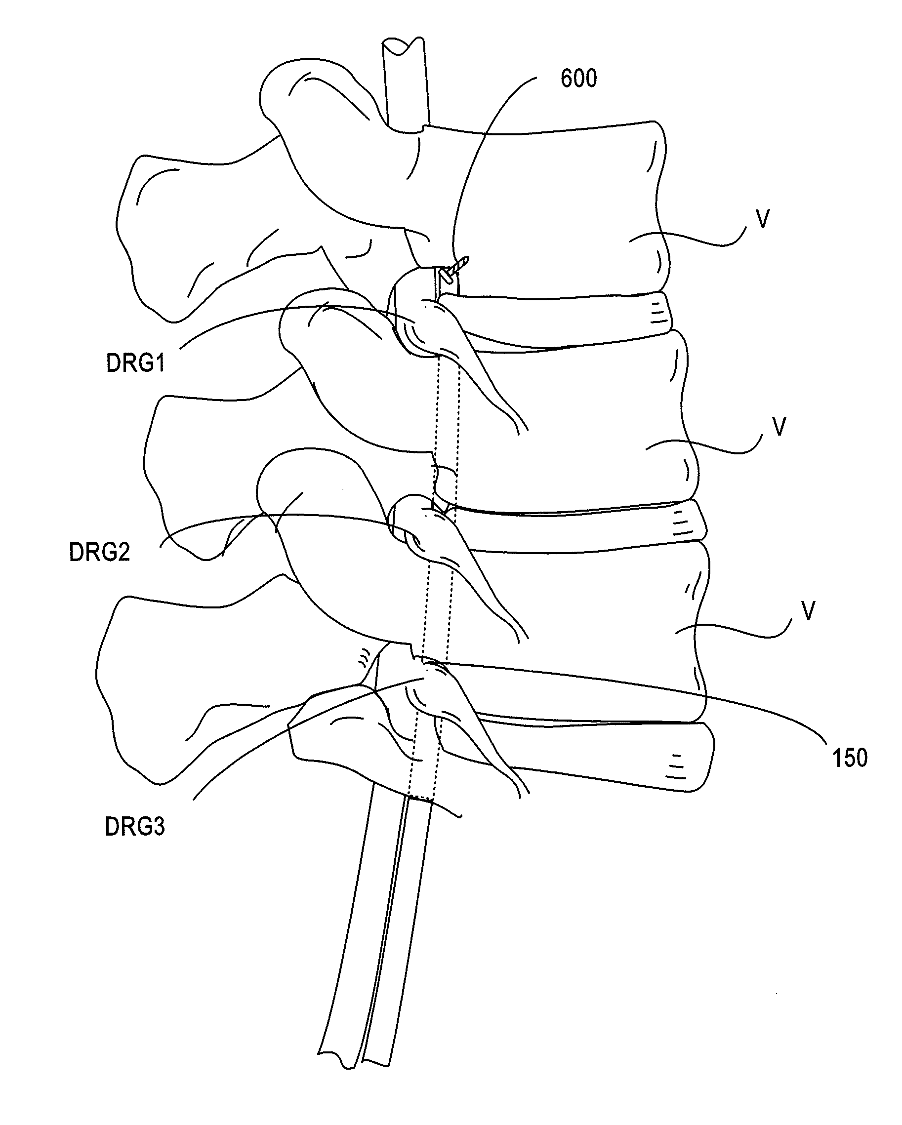 Hard tissue anchors and delivery devices