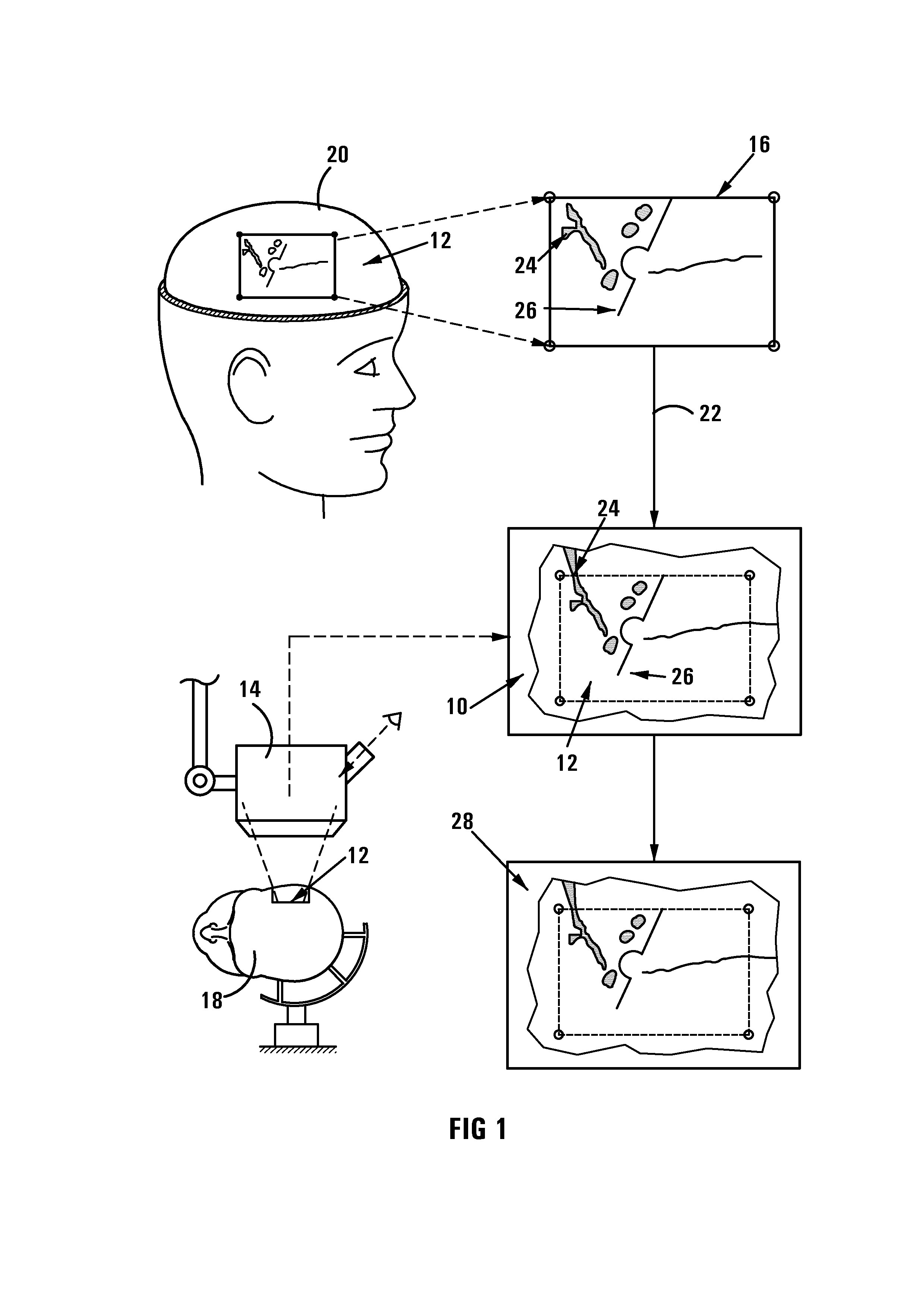 Method of and system for overlaying nbs functional data on a live image of a brain