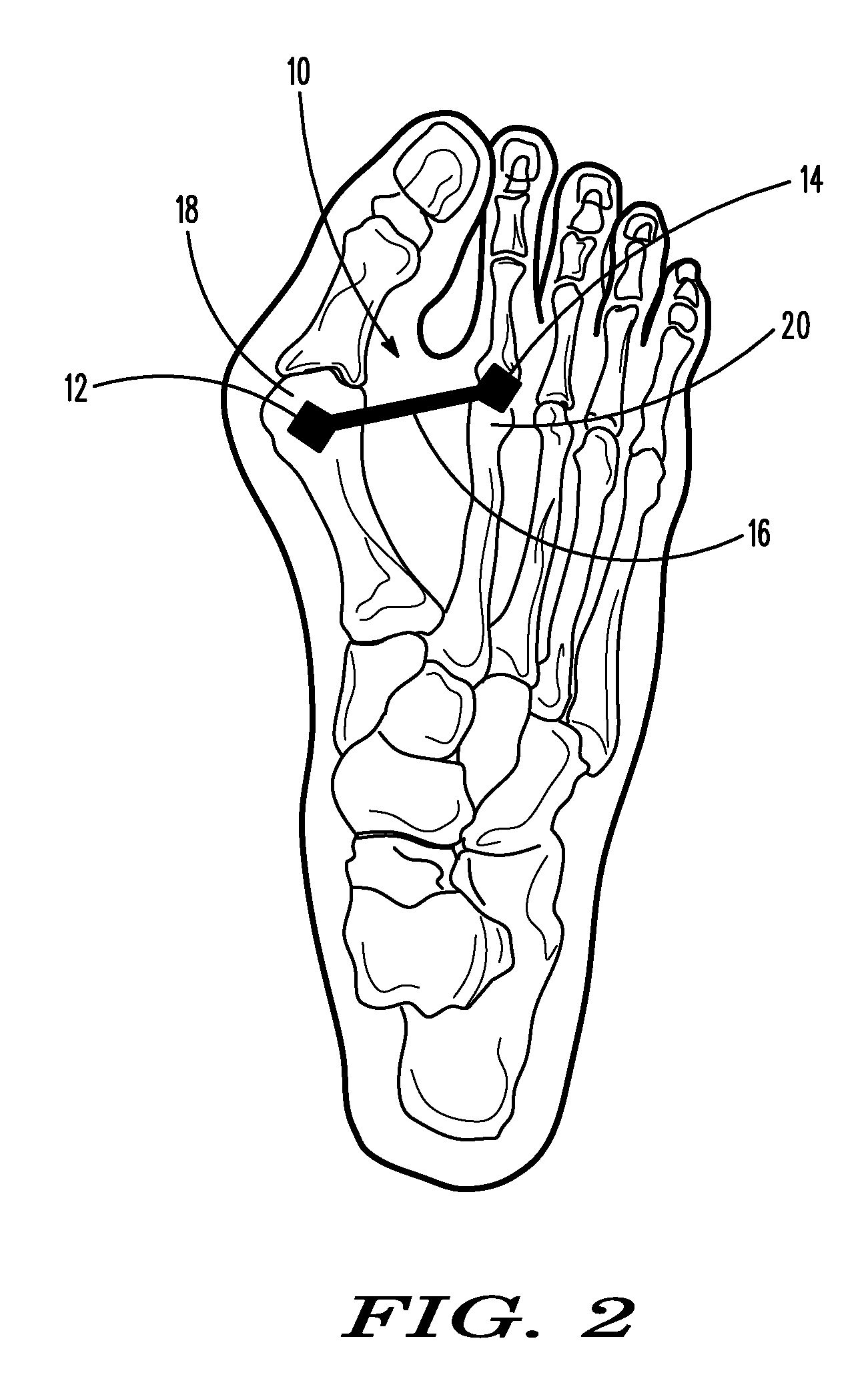 Methods and devices for treating hallux valgus