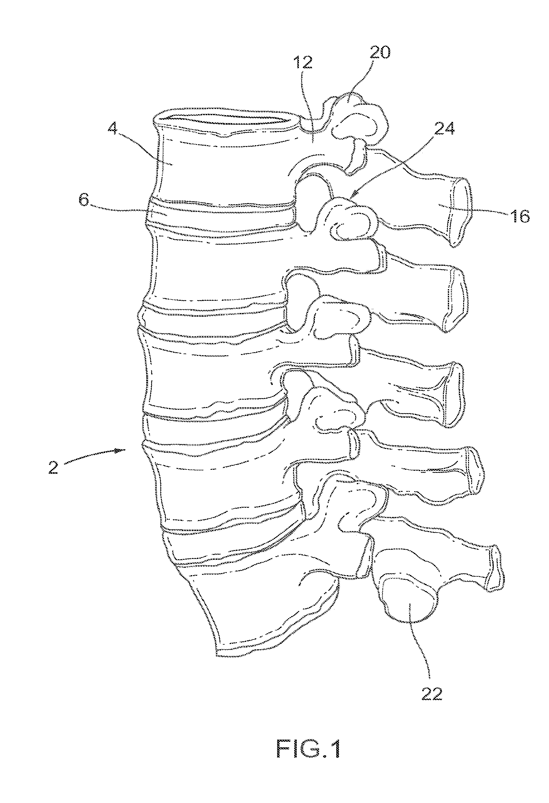 Device and method for reinforcement of a facet