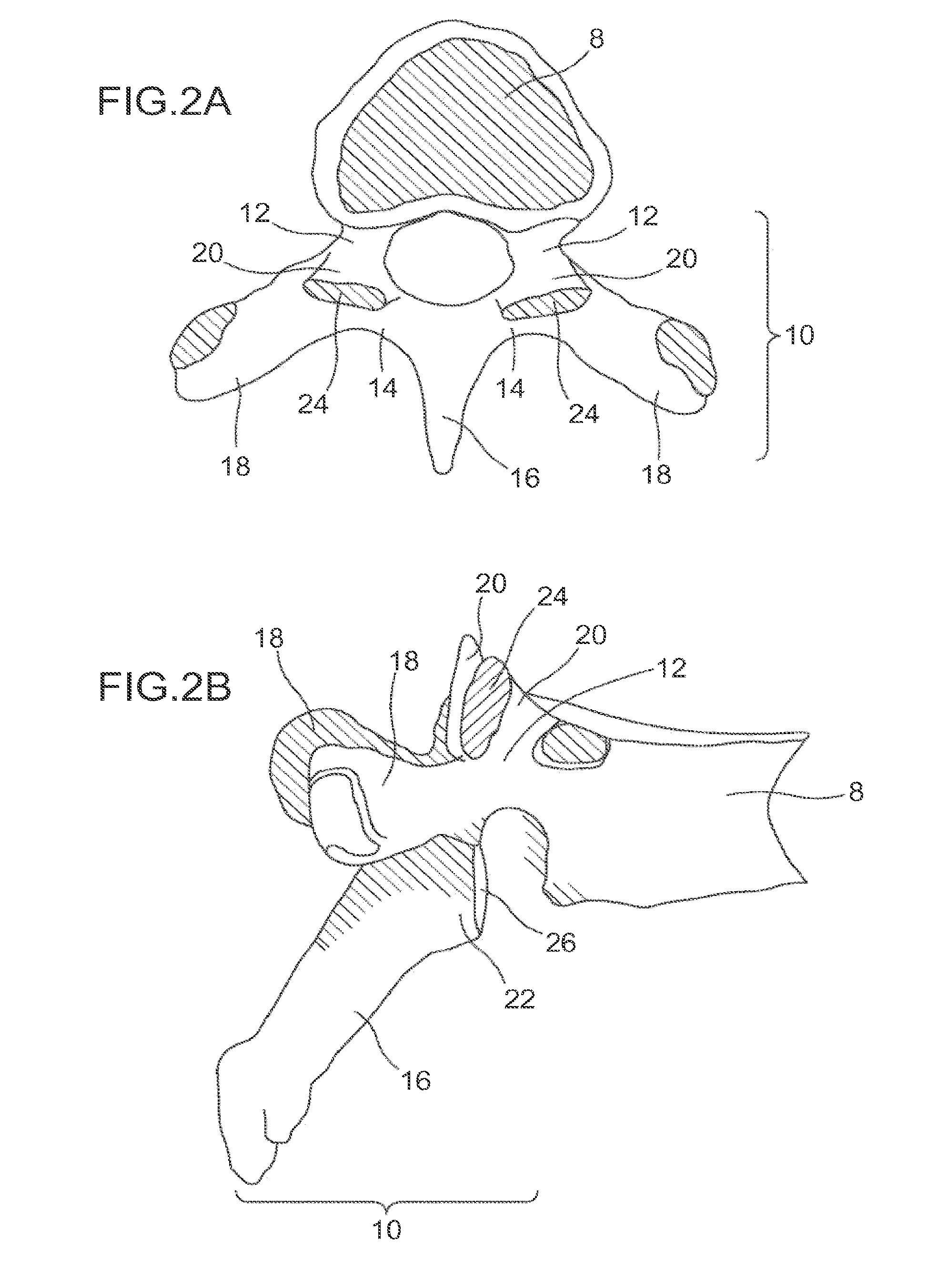 Device and method for reinforcement of a facet