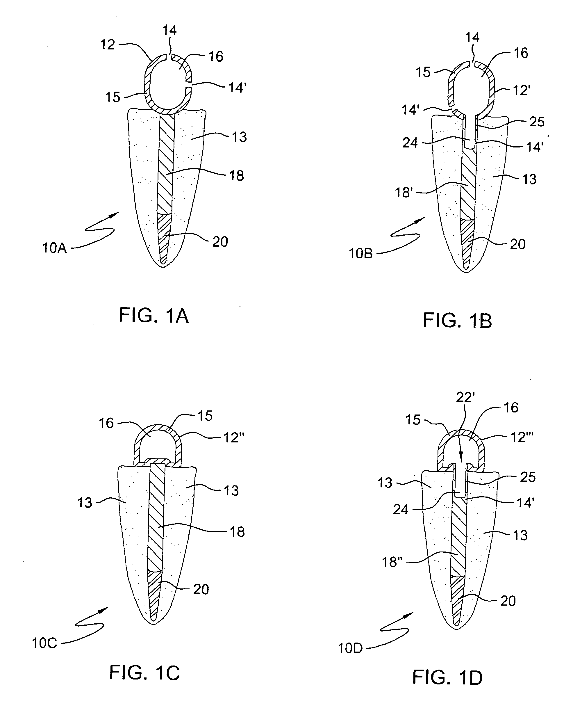 Force redirecting dental core system