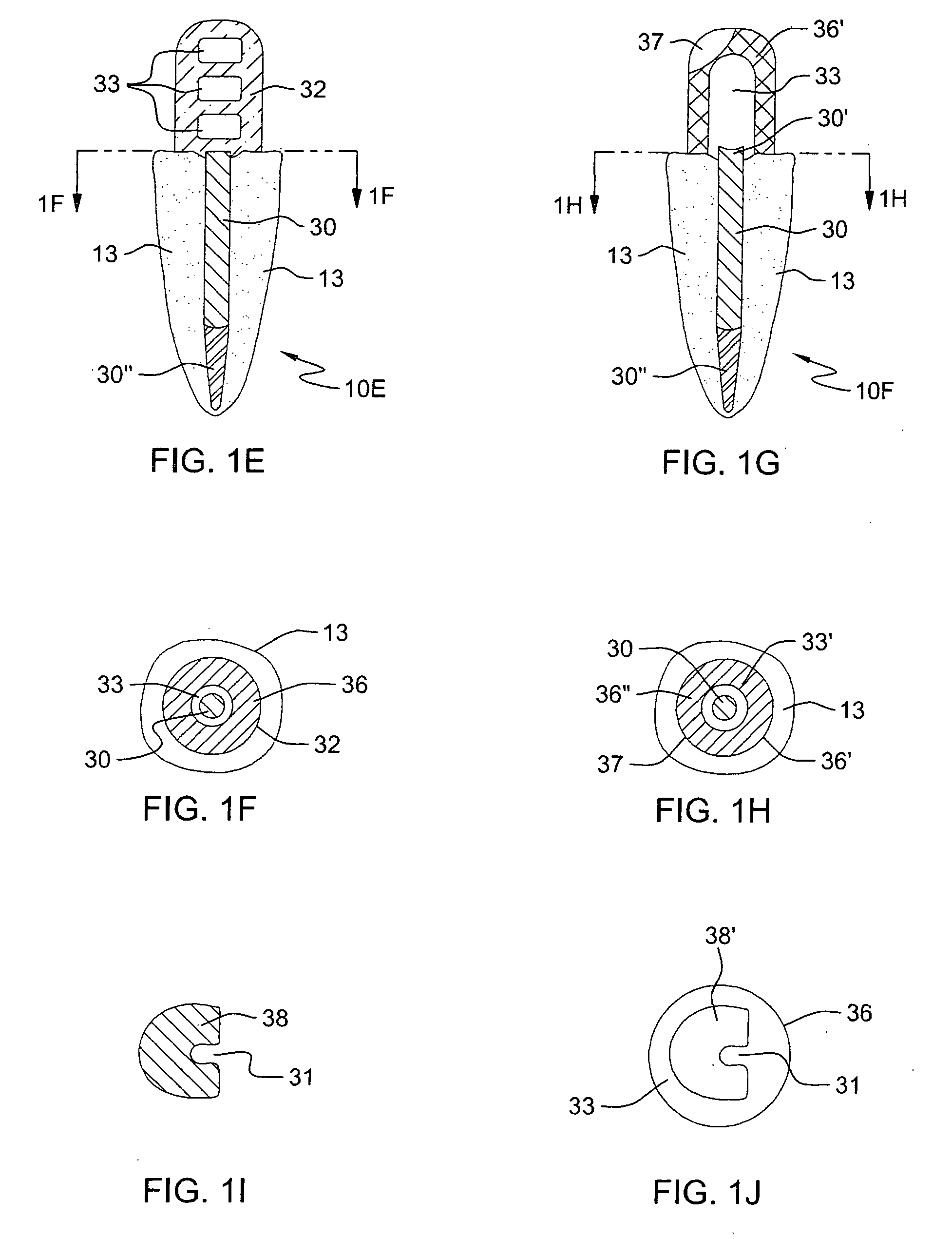 Force redirecting dental core system