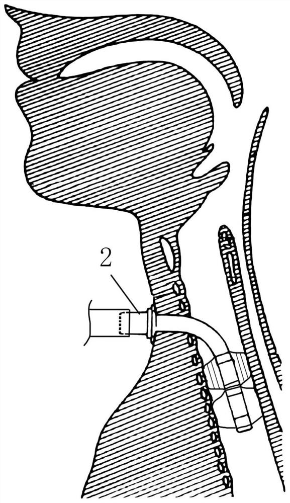 A voice training rehabilitation device after tracheotomy