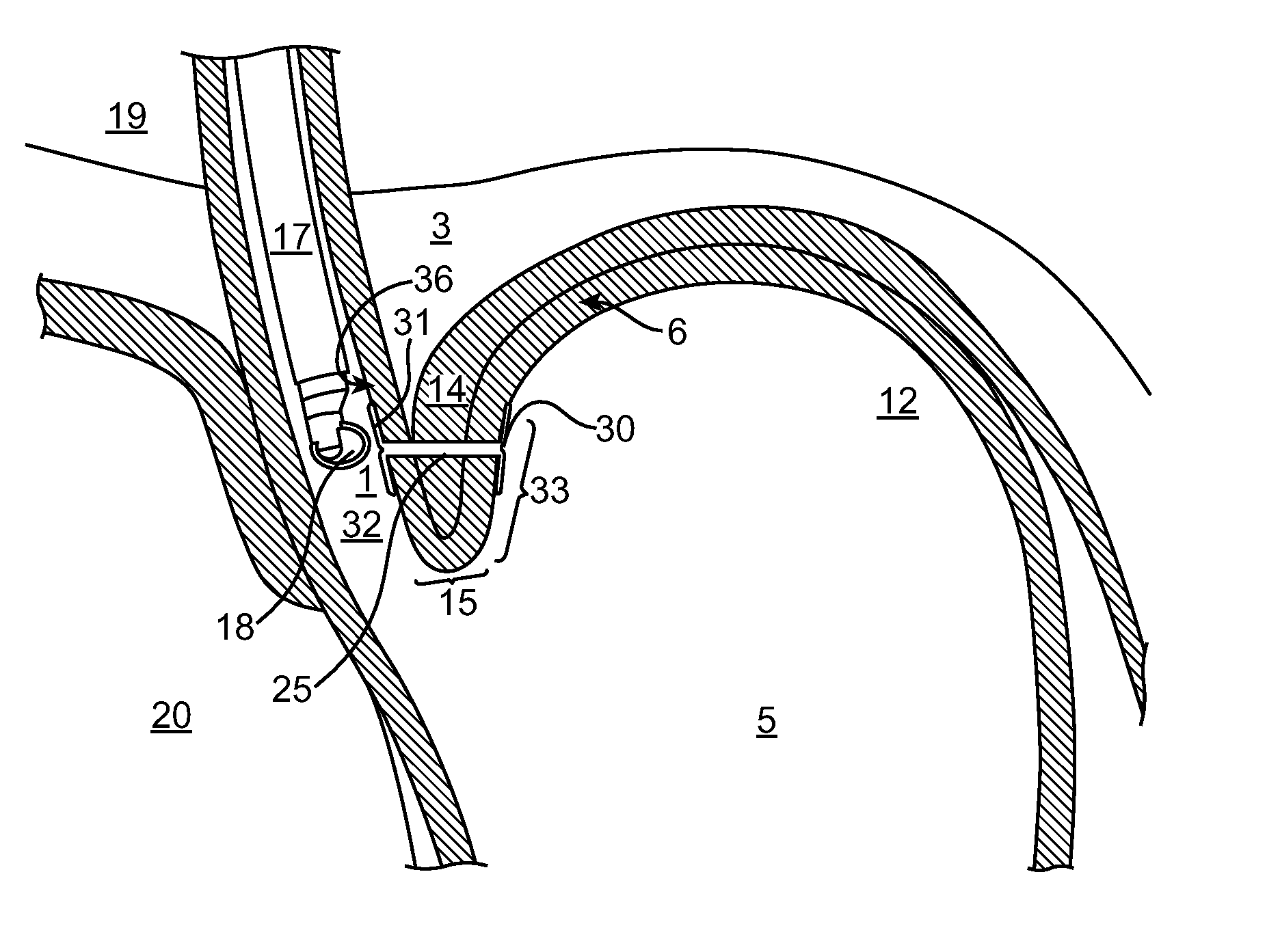 Methods and systems for treating hiatal hernias