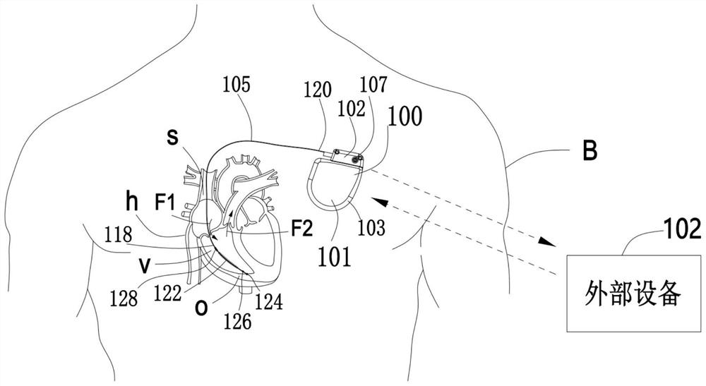 Implanted medical device utilizing blood flow sensor to detect T wave over-perception