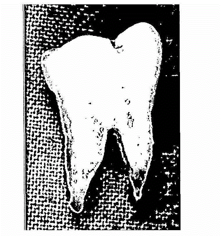Method for processing bone graft material using teeth, and bone graft material processed thereby