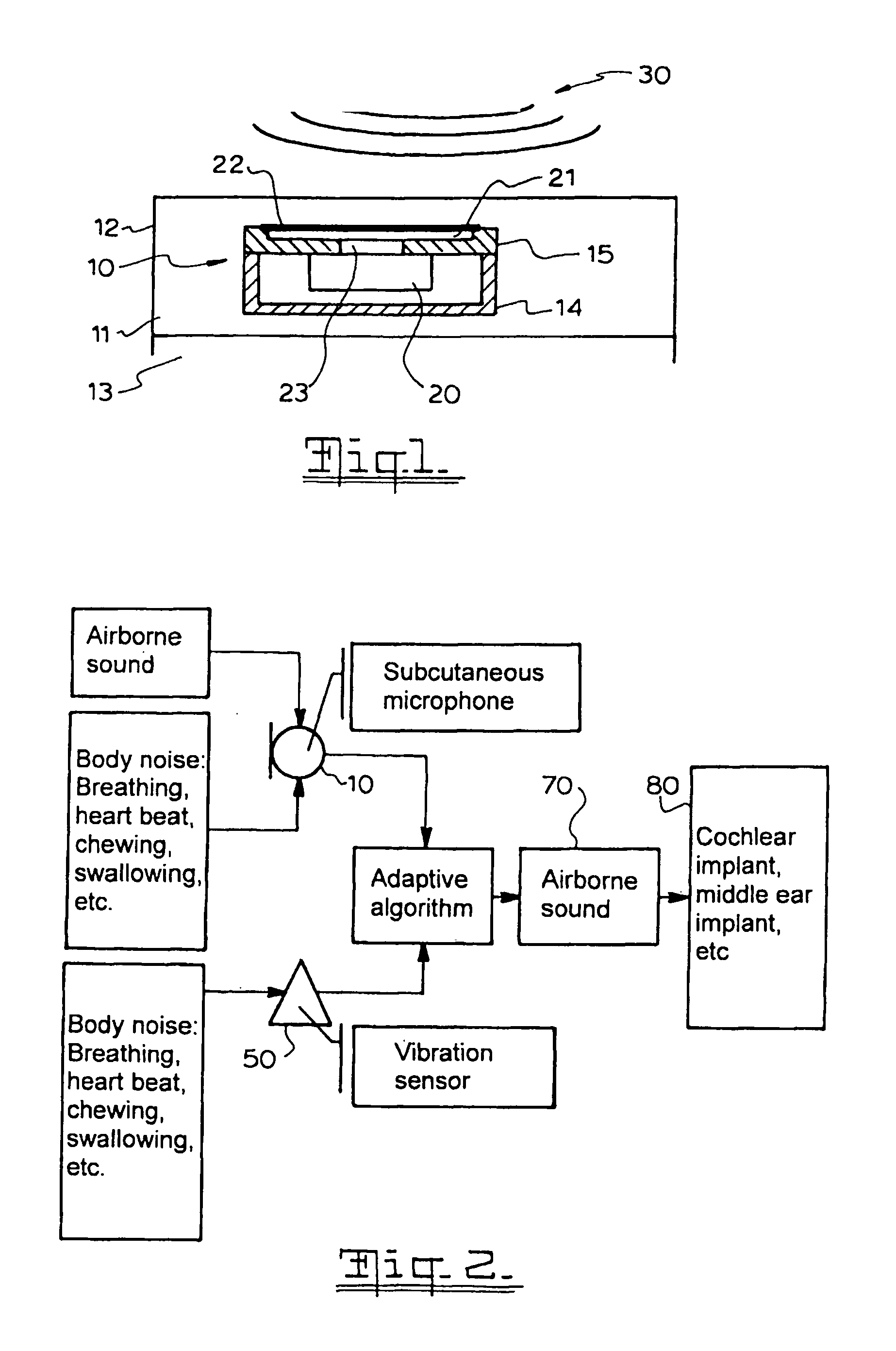 Implantable Microphone System and Calibration Process