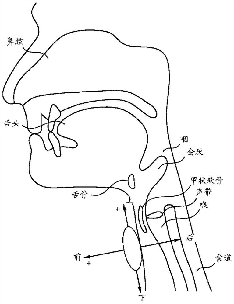 Methods and devices for screening swallowing impairment