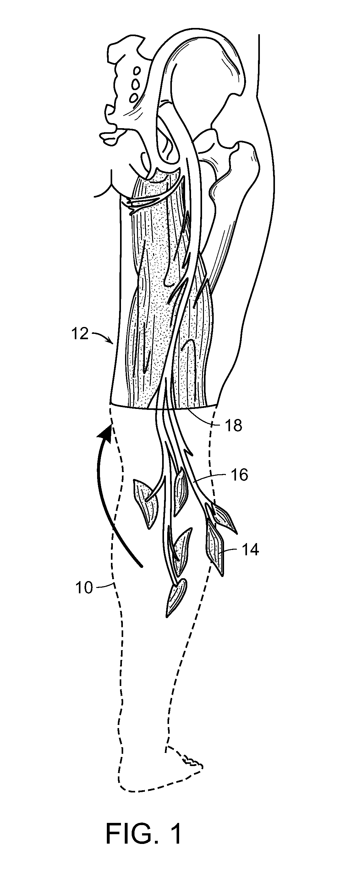 Peripheral neural interface via nerve regeneration to distal tissues