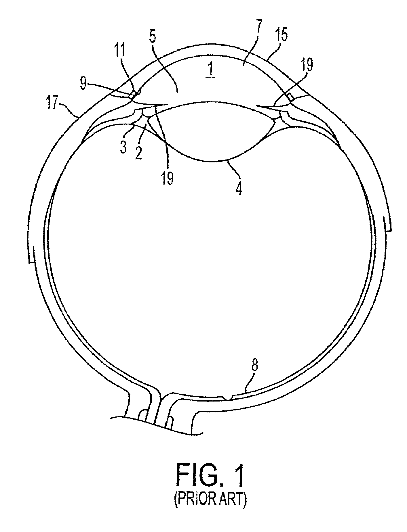 Delivery system and method of use for the eye