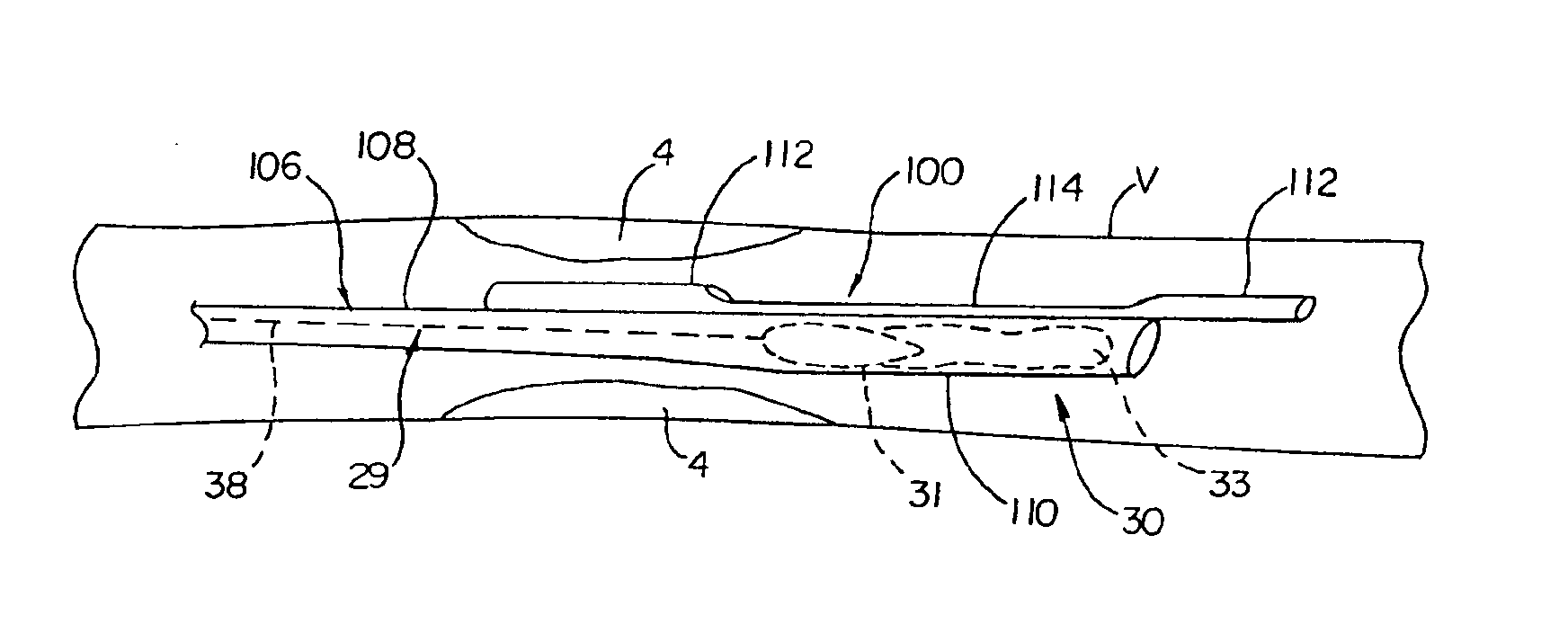 Vascular embolic filter exchange devices and methods of use thereof