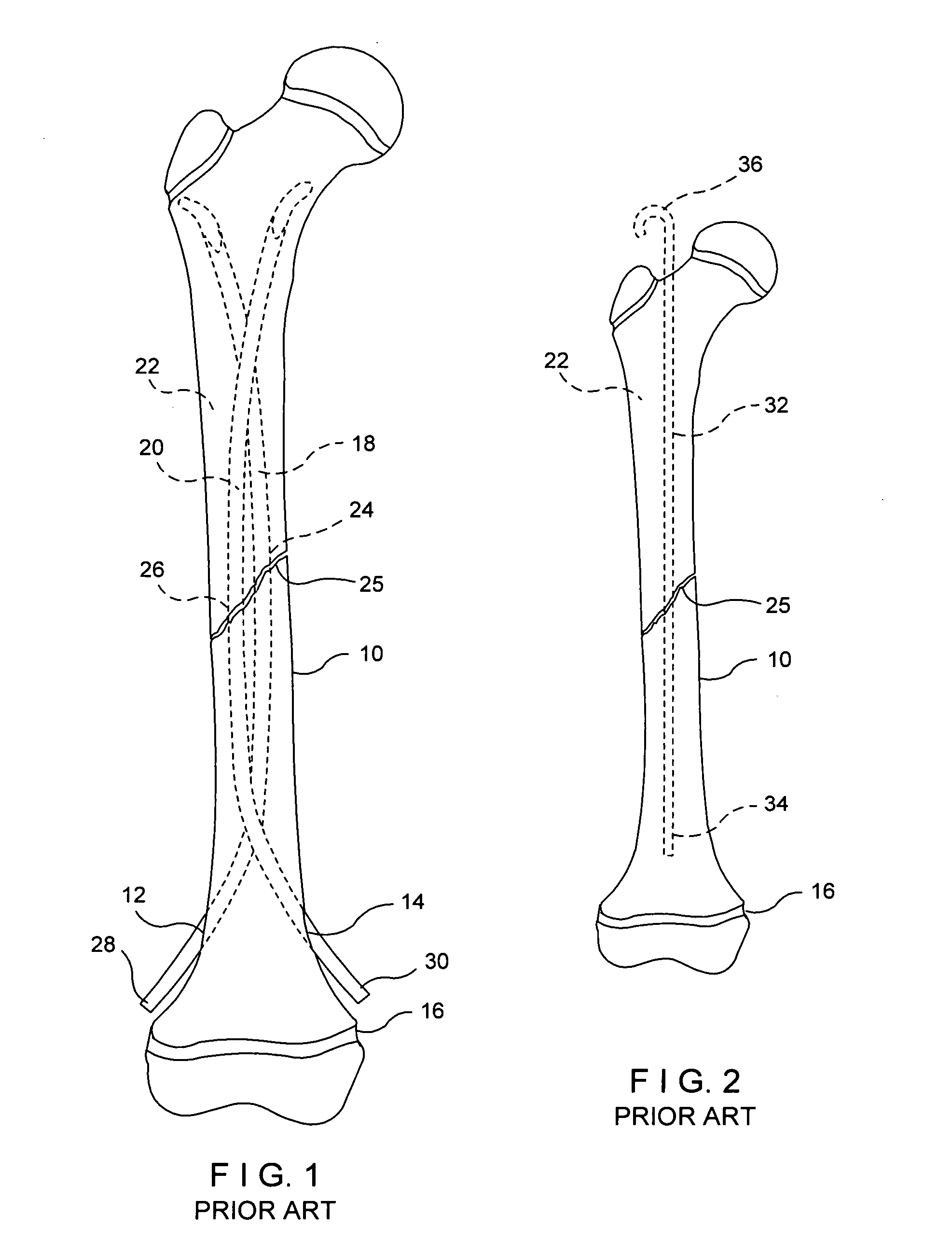 System for intramedullary rod fixation and method therefor