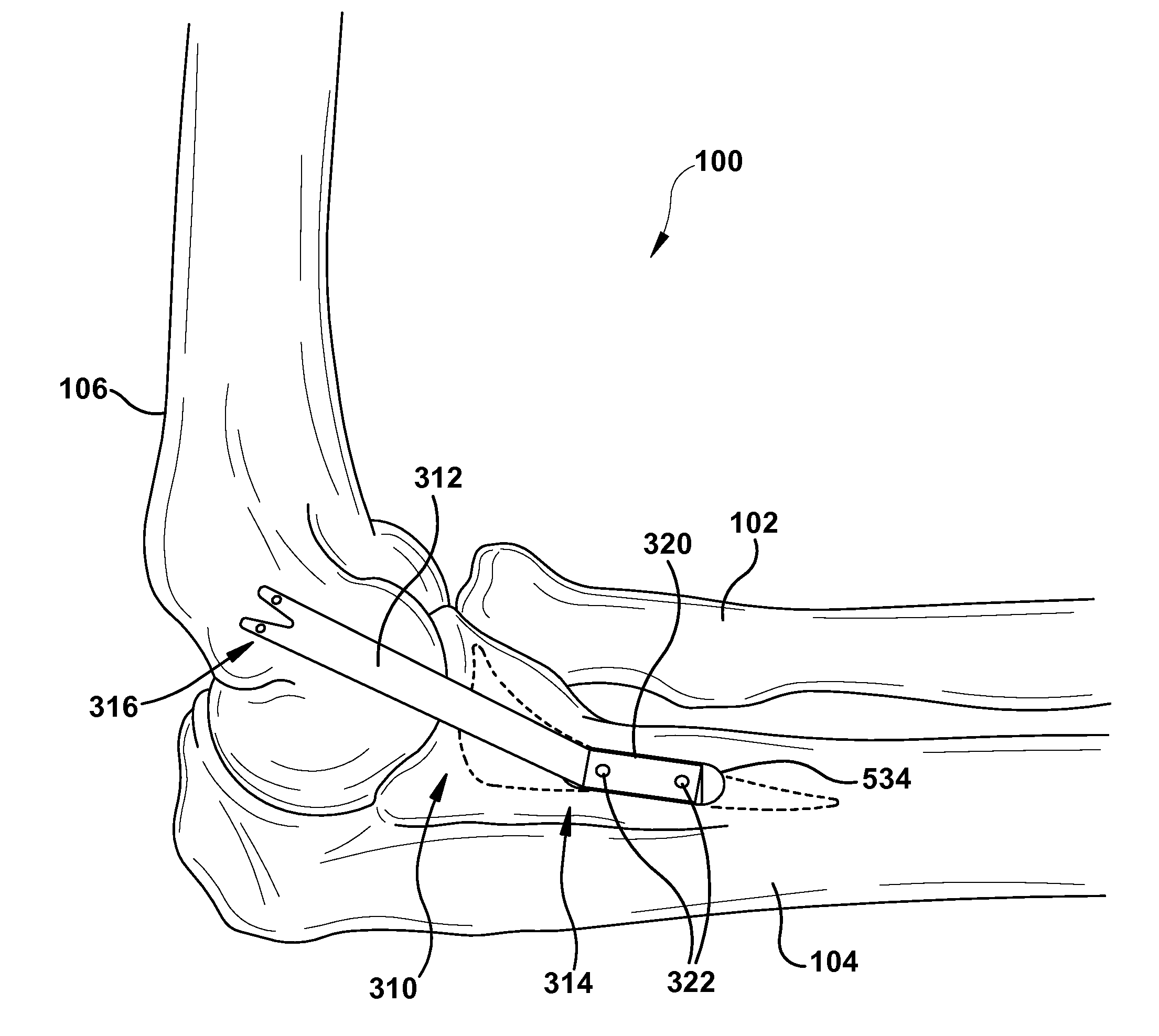 Method and apparatus for providing a soft-tissue transplant to a receiving bone