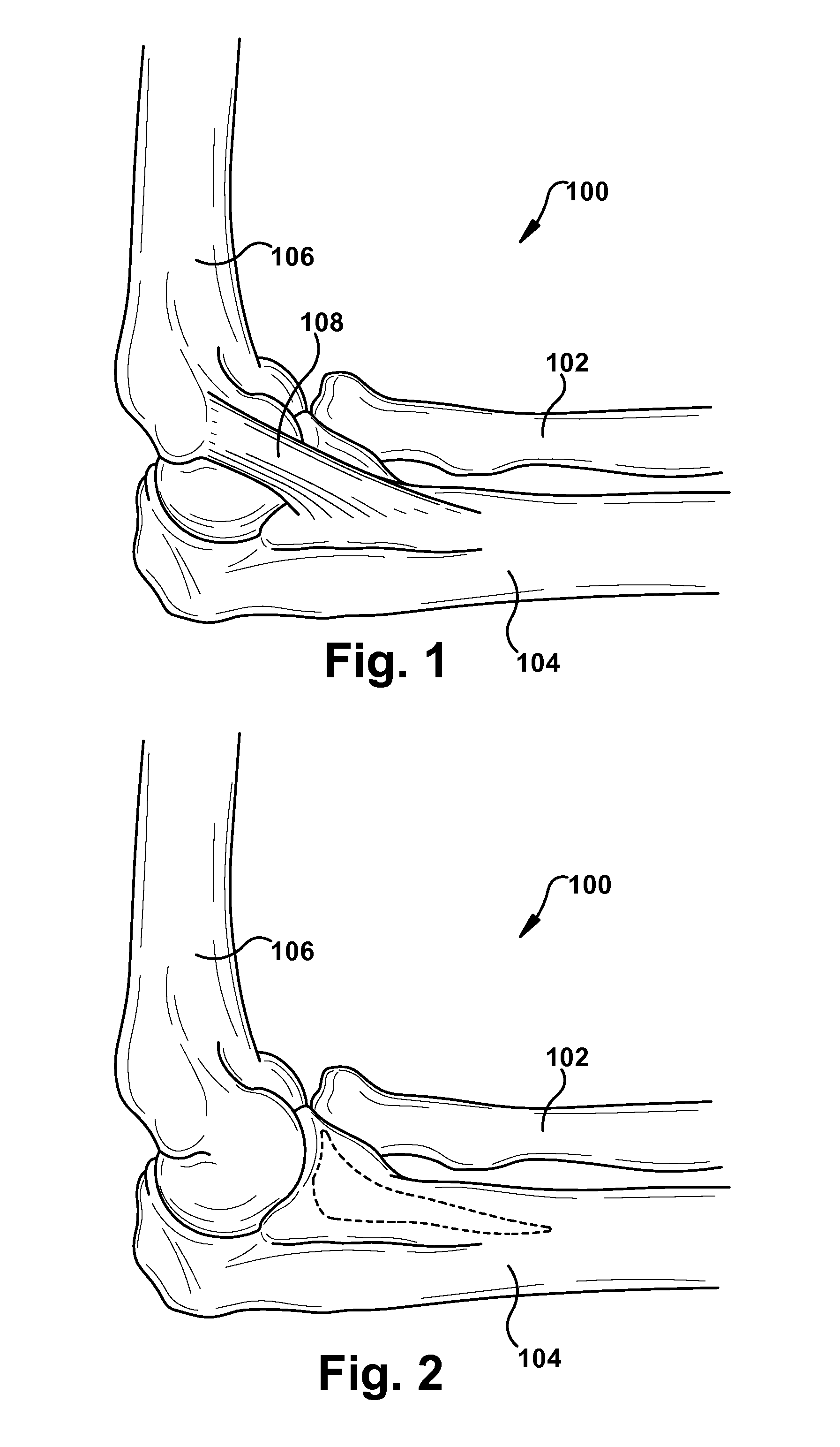 Method and apparatus for providing a soft-tissue transplant to a receiving bone