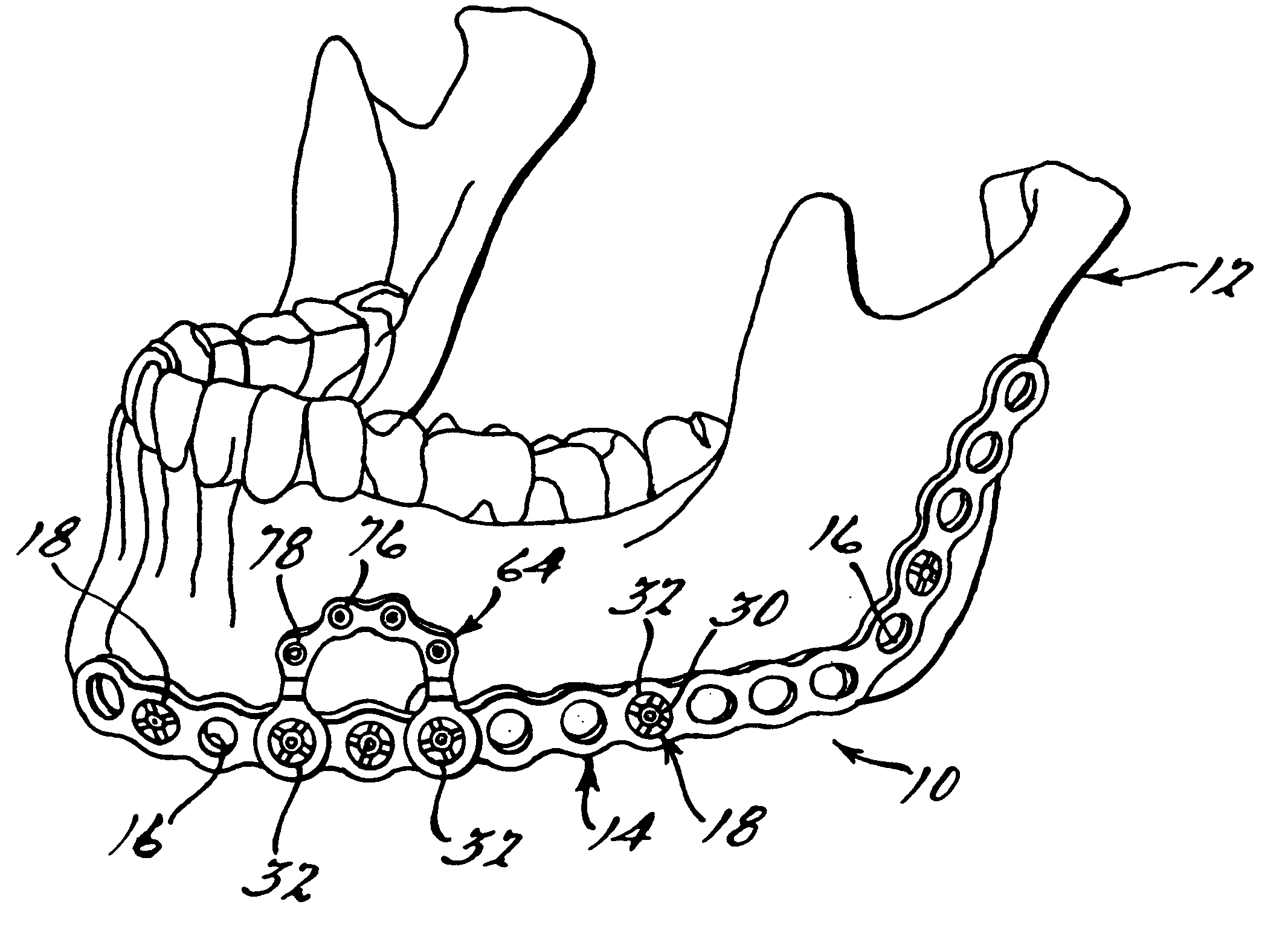 Method and apparatus for mandibular osteosynthesis