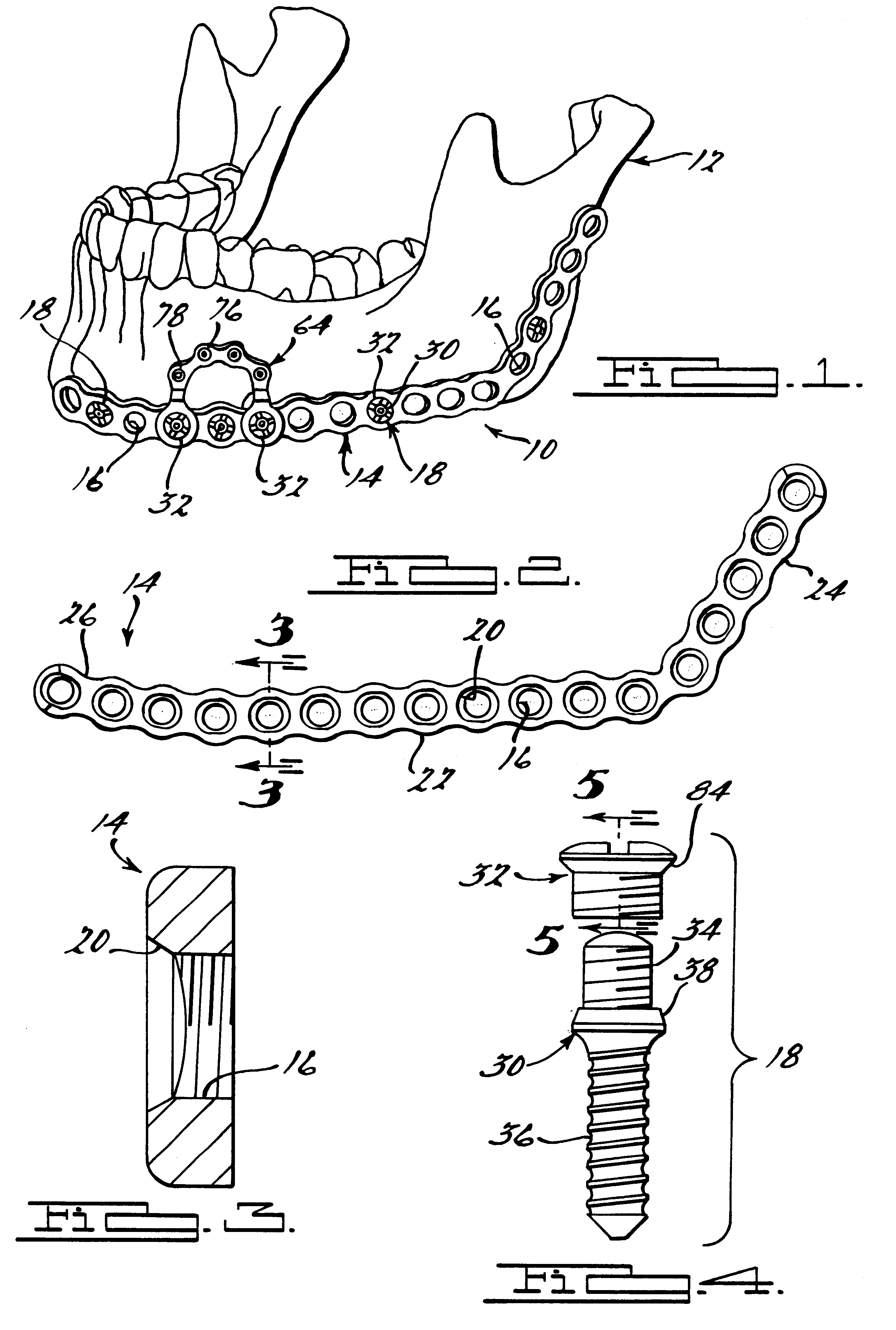 Method and apparatus for mandibular osteosynthesis