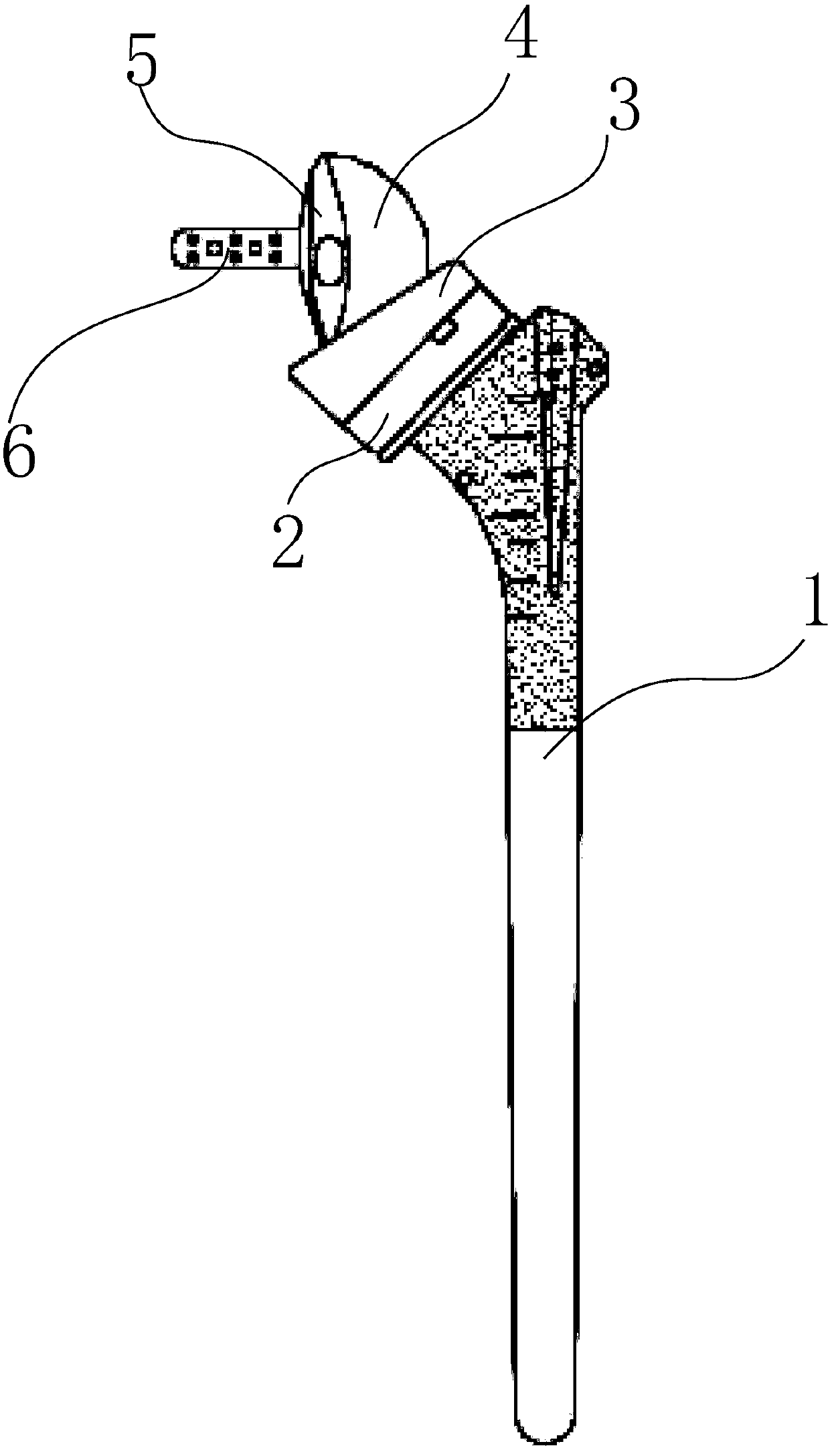 Assembled shoulder joint prosthesis component