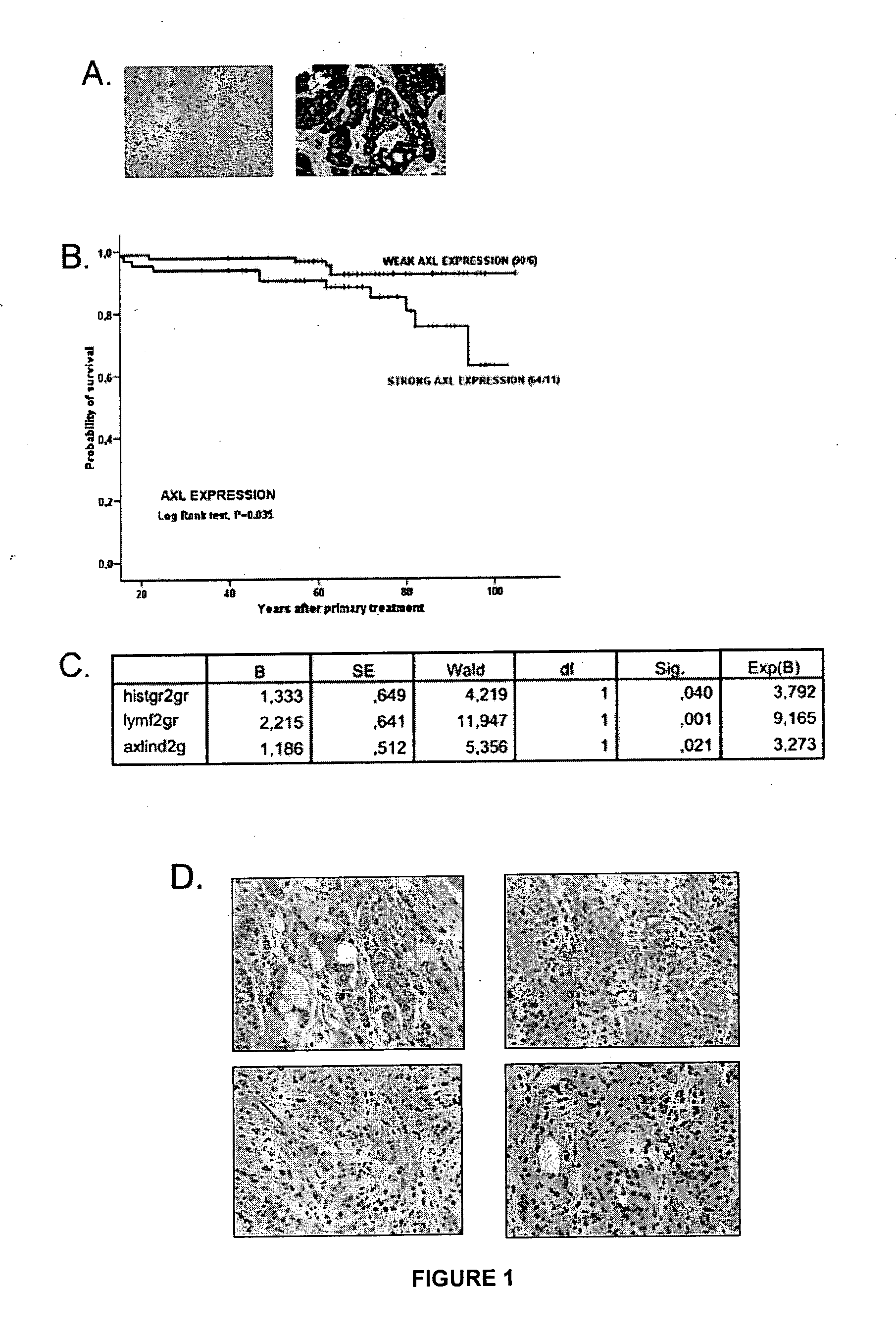 Methods using axl as a biomarker of epithelial-to-mesenchymal transition