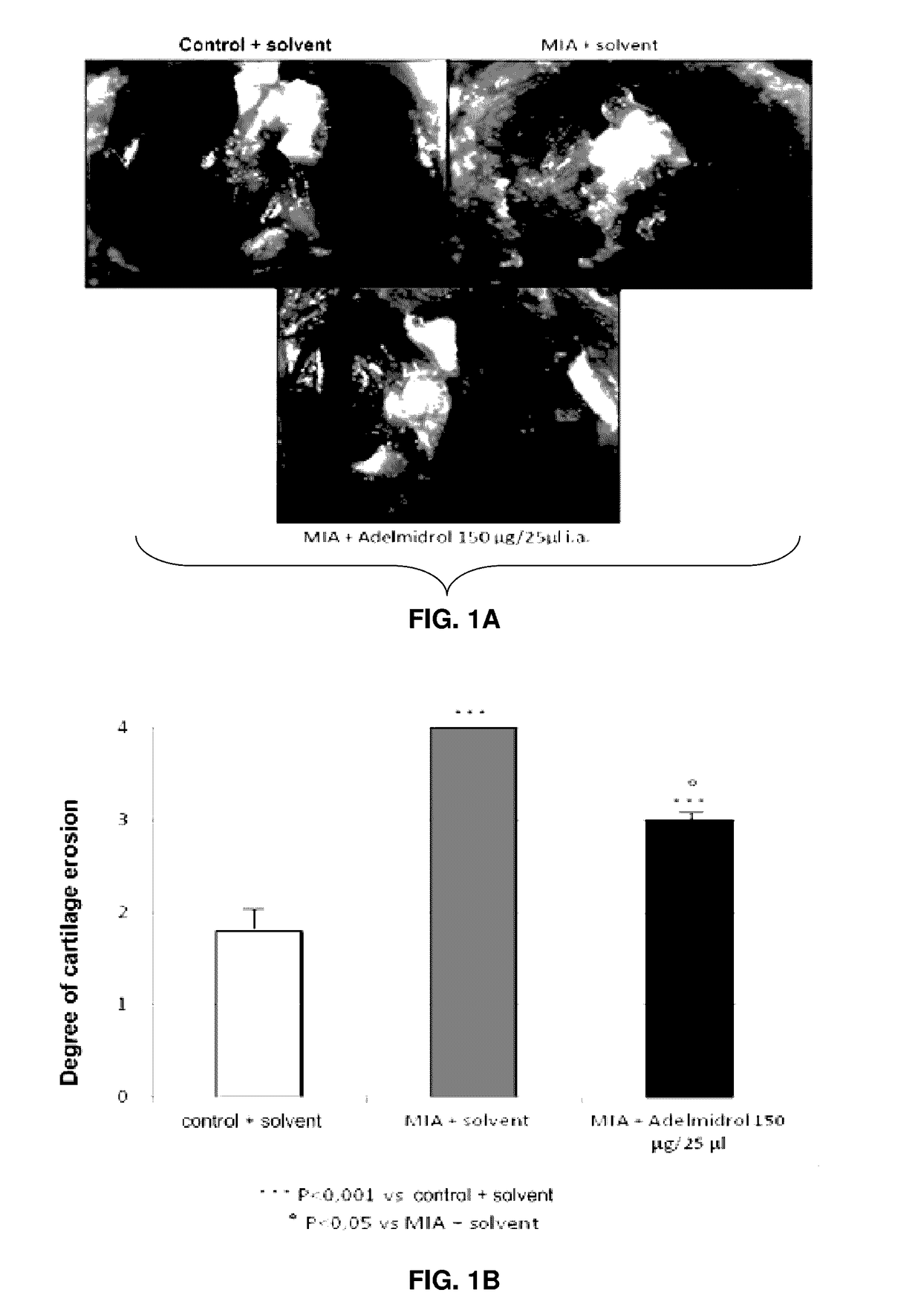 Adelmidrol For Use In Diseases Characterized By Insufficient Agonism Of PPAR-GAMMA Receptor