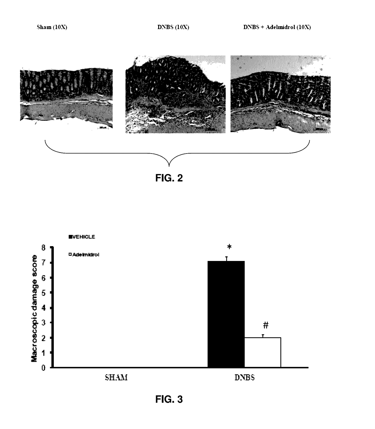 Adelmidrol For Use In Diseases Characterized By Insufficient Agonism Of PPAR-GAMMA Receptor