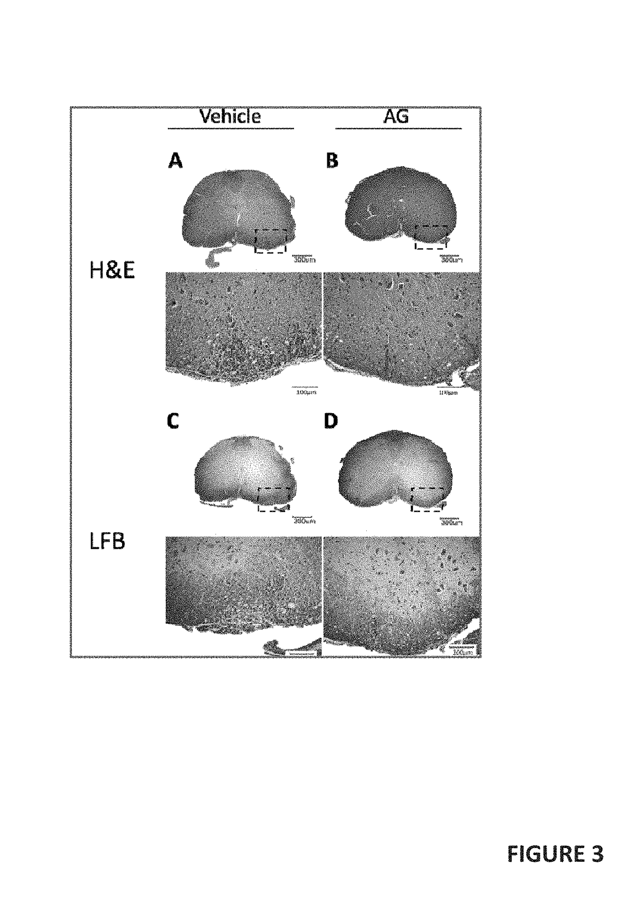 Andrographolide Treats Progressive Forms of Multiple Sclerosis