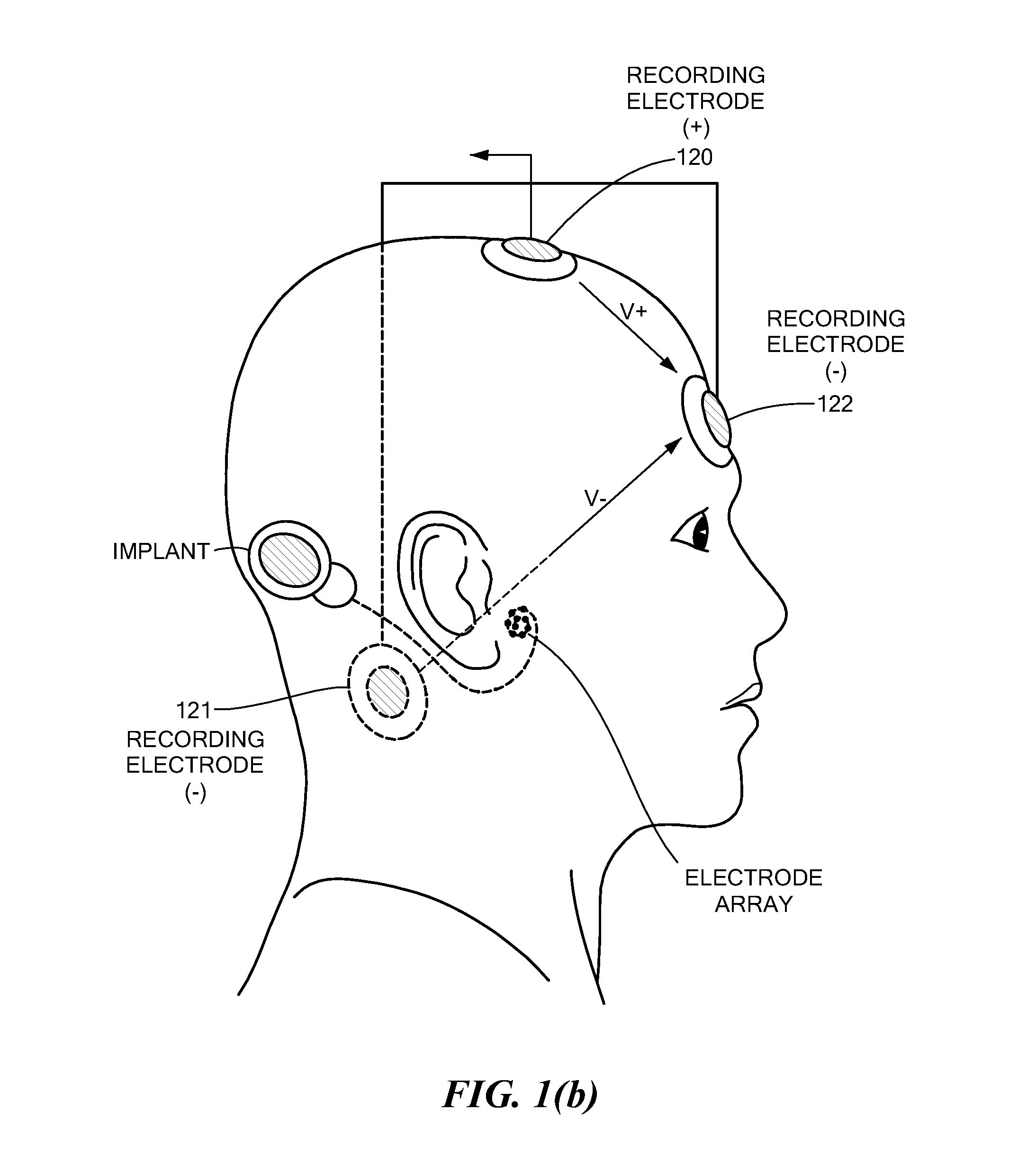 Electrically evoked brainstem response measurements via implant prothesis