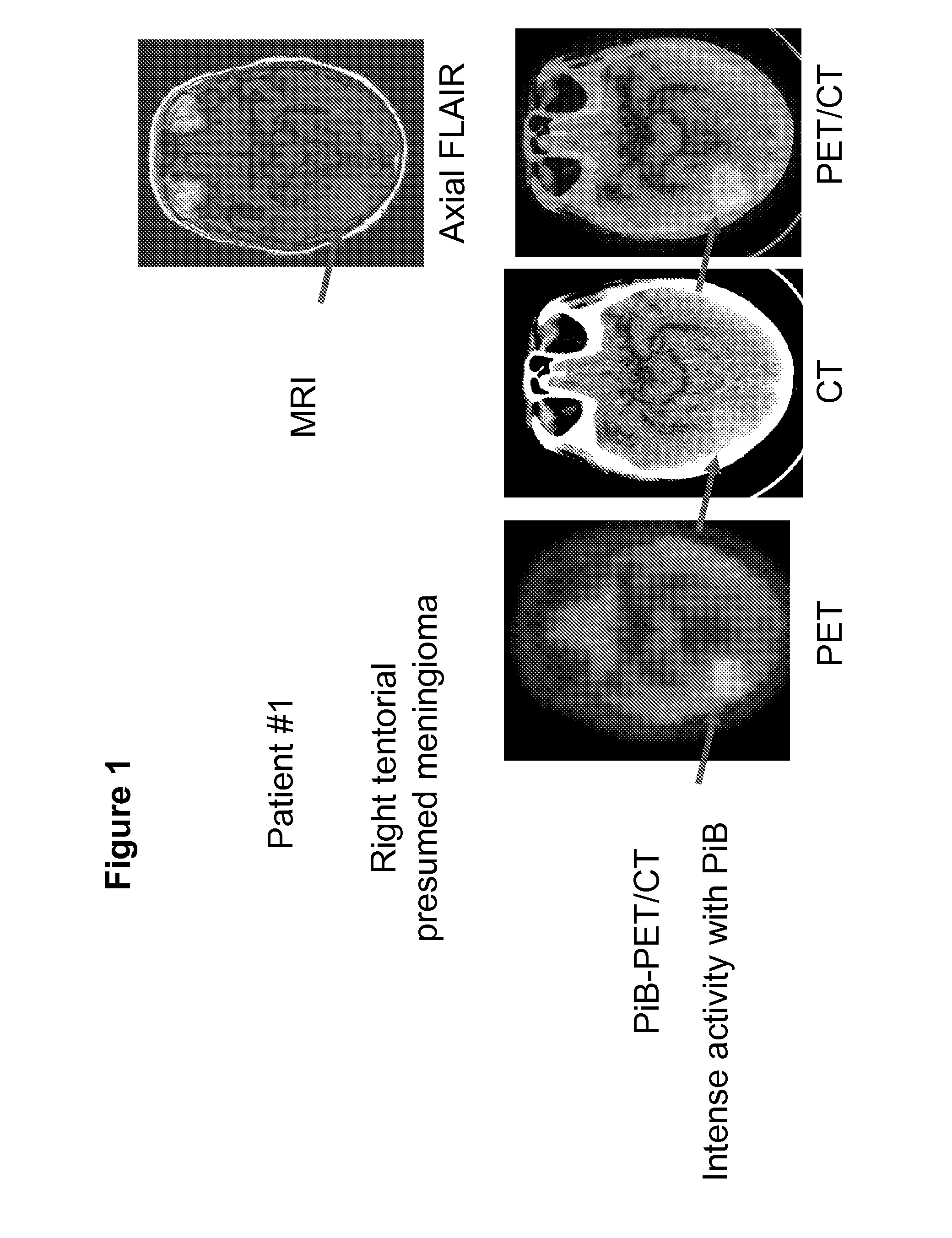 Imaging of meningiomas using phingylbenzothiazole, stilbene, or biphenylalkyne derivatives