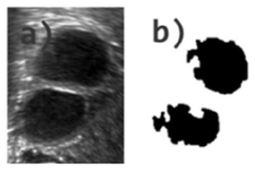 Follicle ultrasonic processing method and system based on level set image segmentation