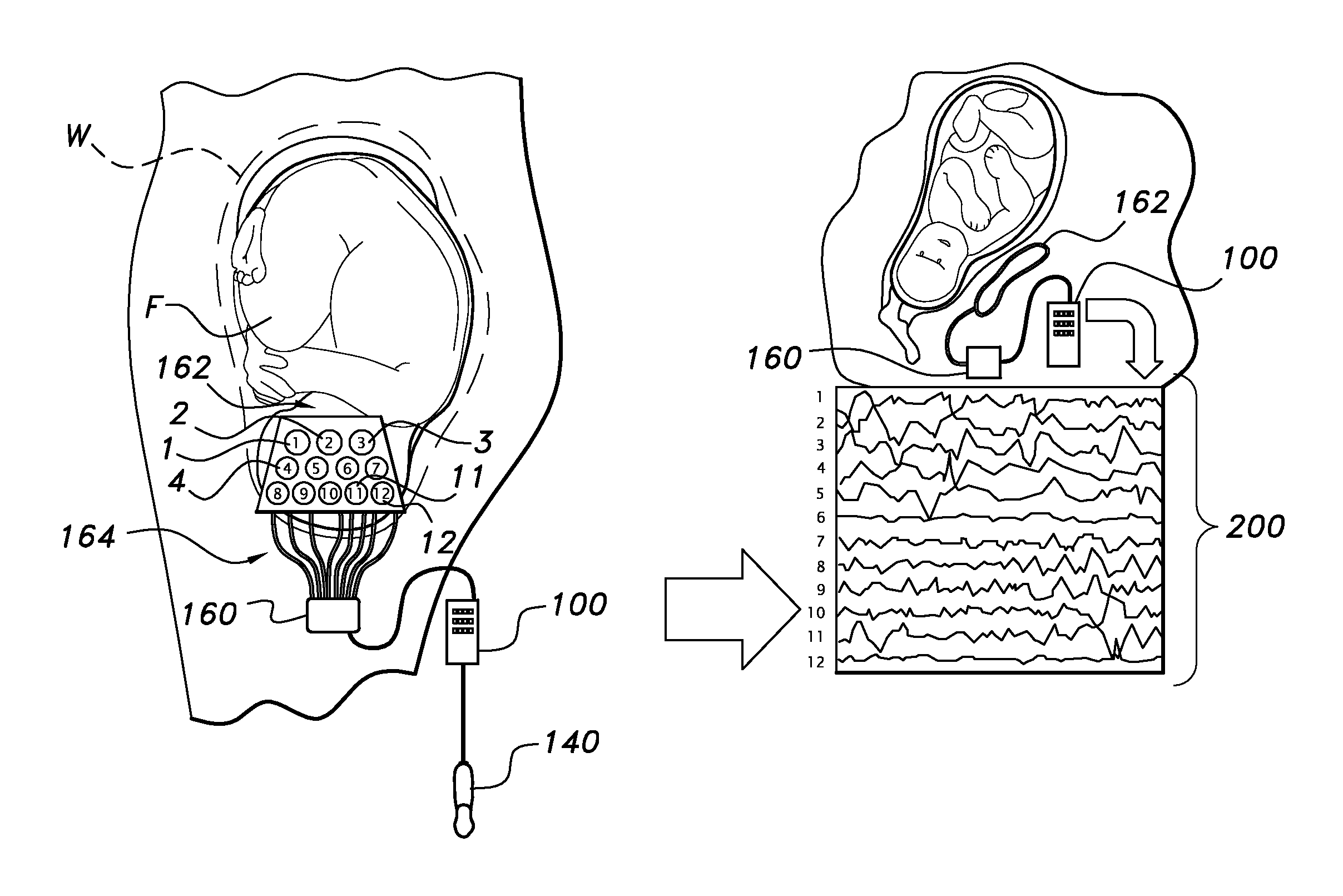 Portable fetal eeg-recording device and method of use