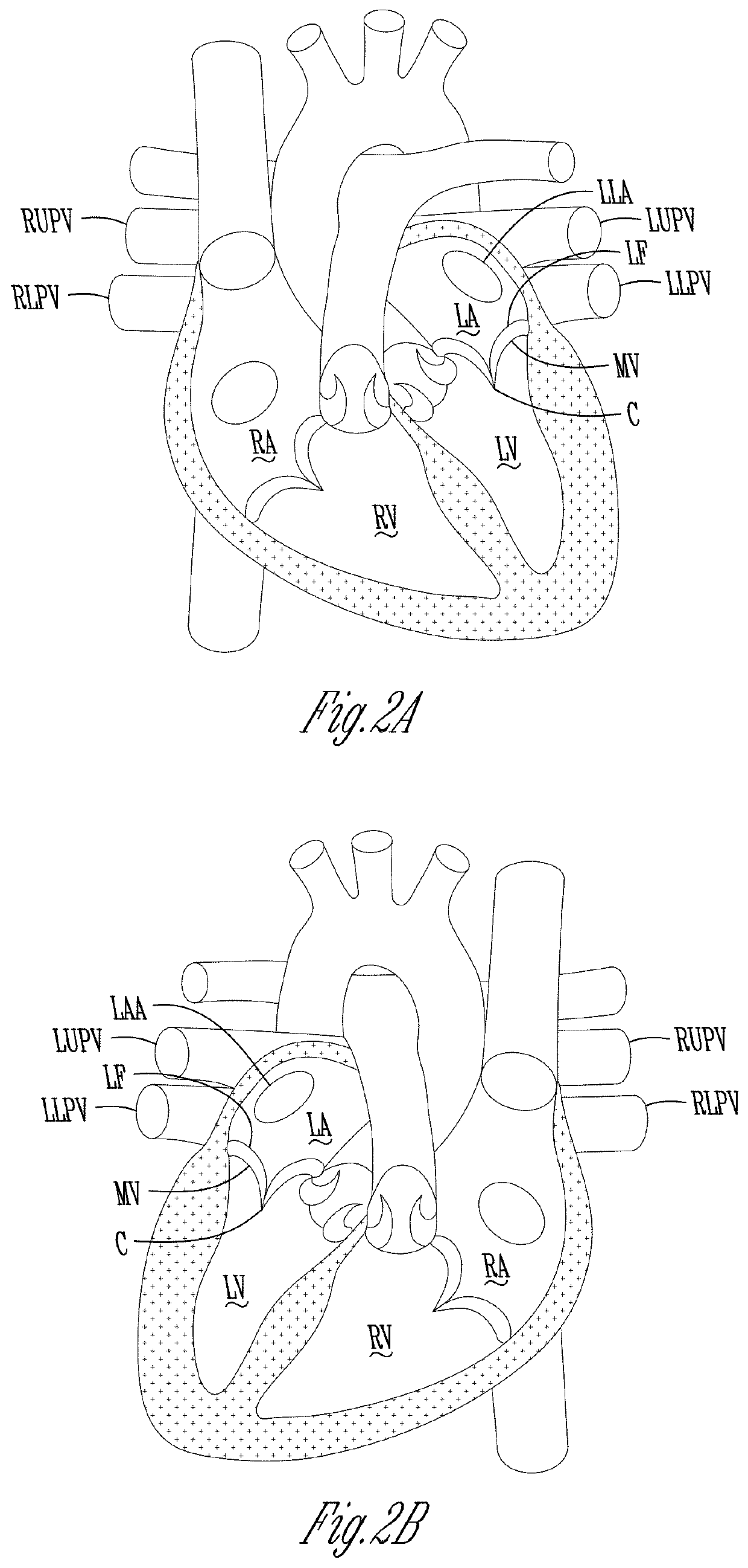 Devices, systems and methods for cardiac treatment