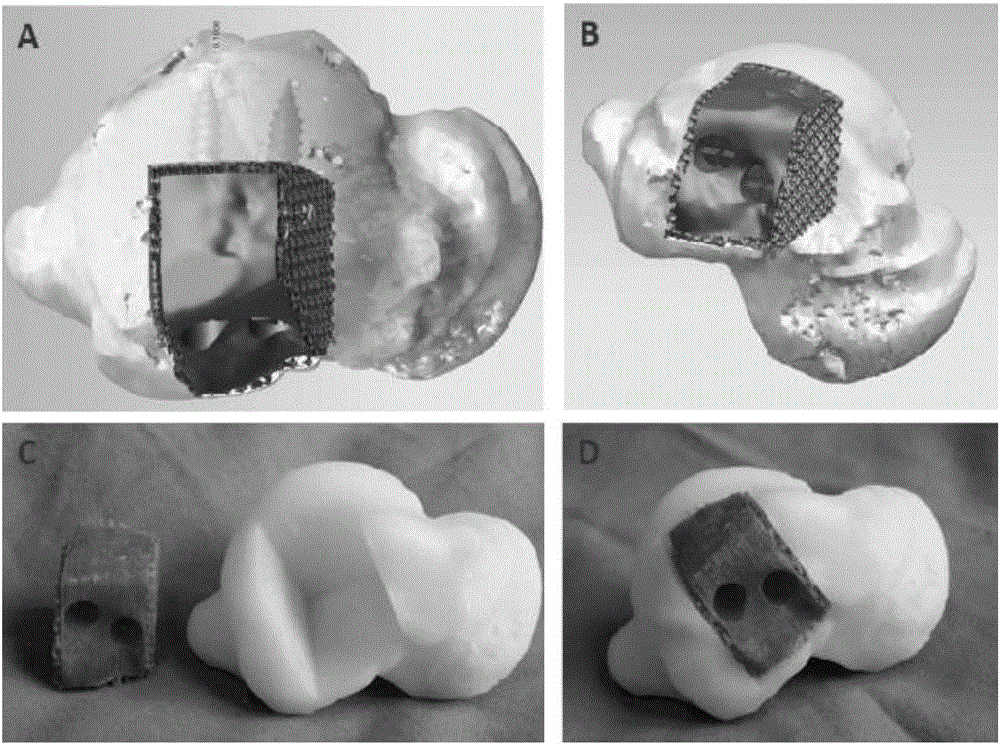 3D-printing-based restoration rebuilding method of large-range osteochondral lesions of talus