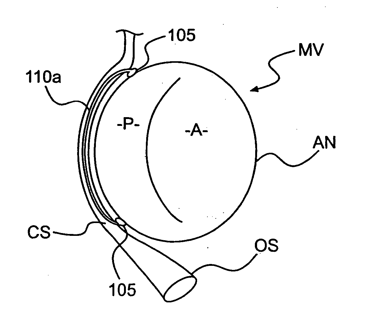 Devices and methods for heart valve treatment