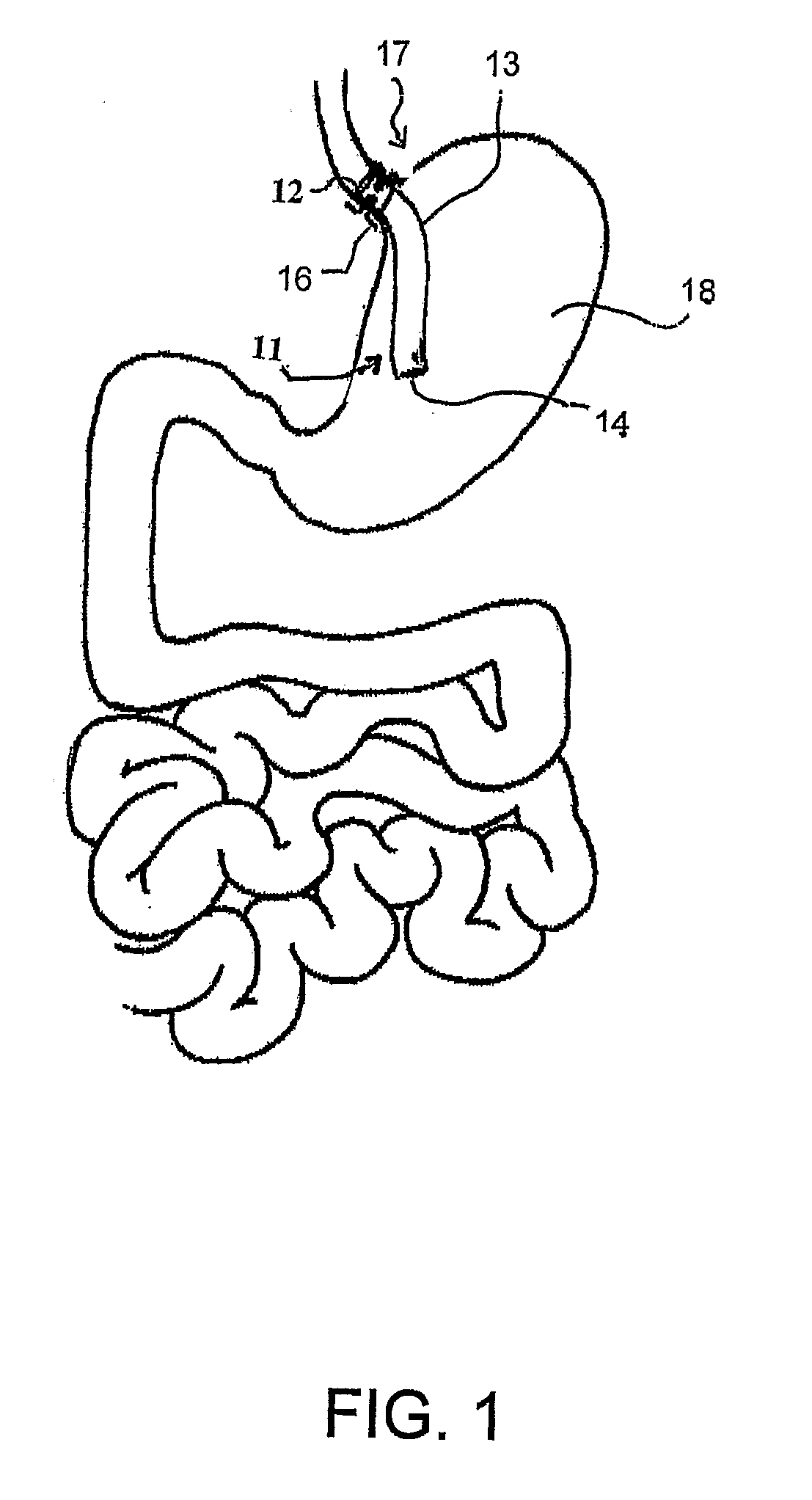 Medical Device and Method For Controlling Obesity