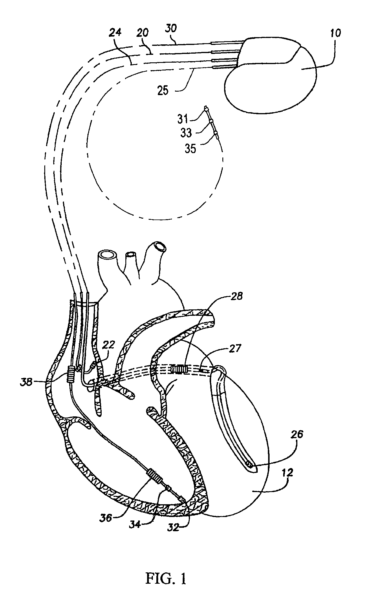 Implantable devices, and methods for use therewith, for monitoring sympathetic and parasympathetic influences on the heart