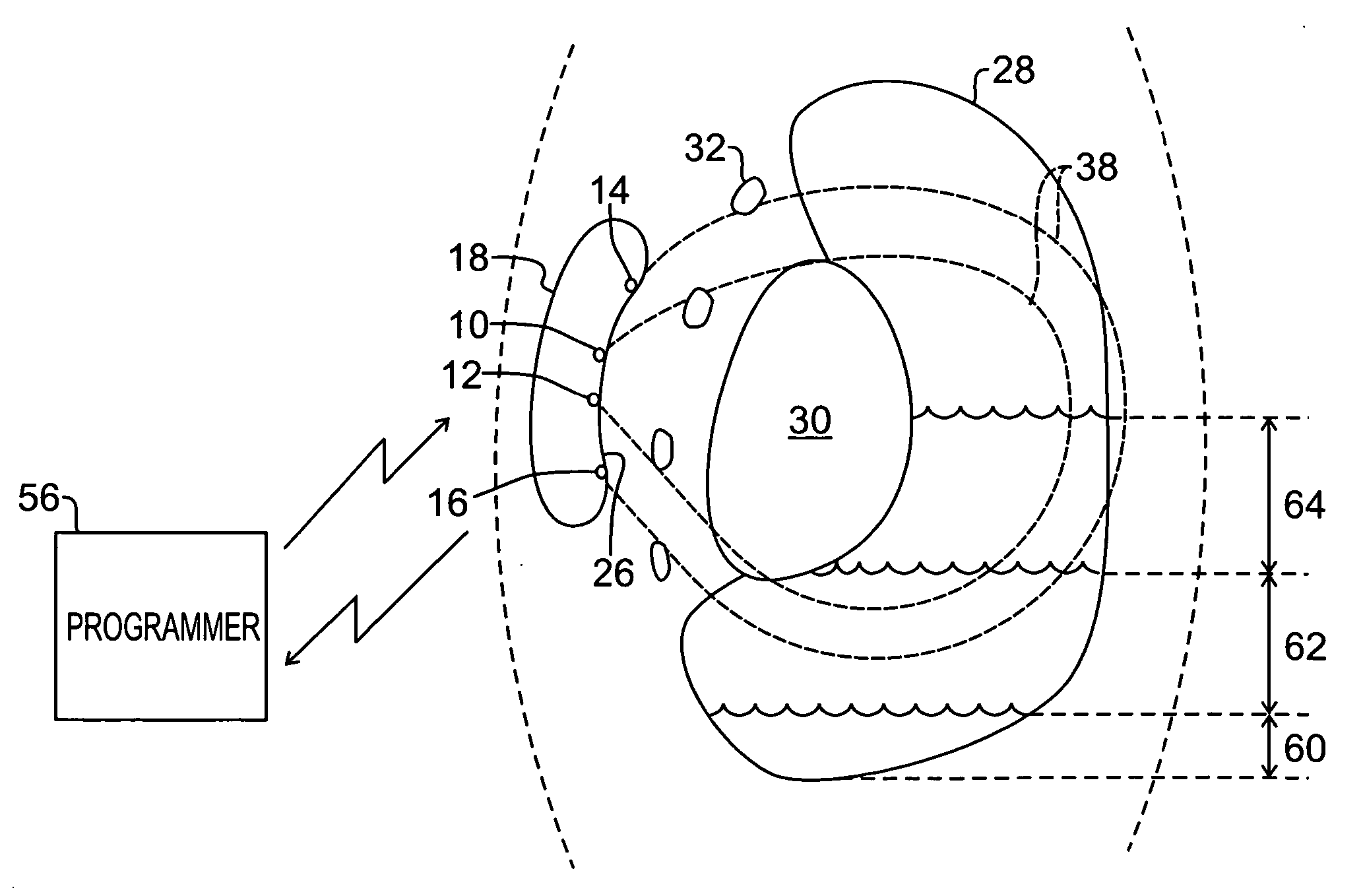 Remote control of implantable device through medical implant communication service band
