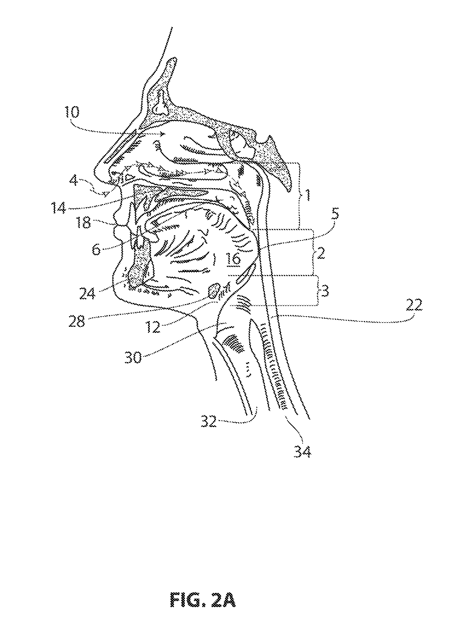 Systems and methods for treatment of sleep apnea