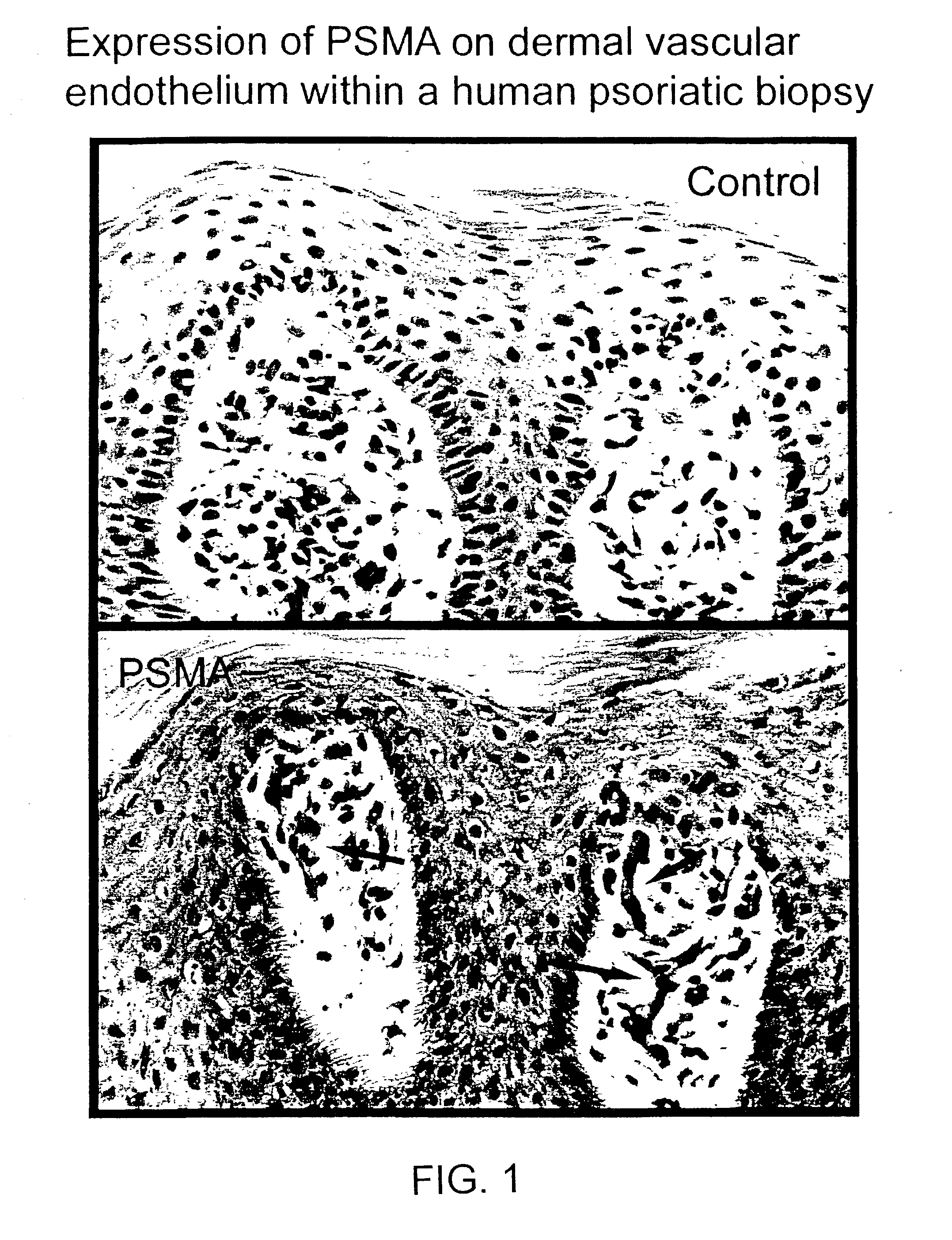 Methods and compositions for treating or preventing skin disorders using binding agents specific for prostate specific membrane antigen