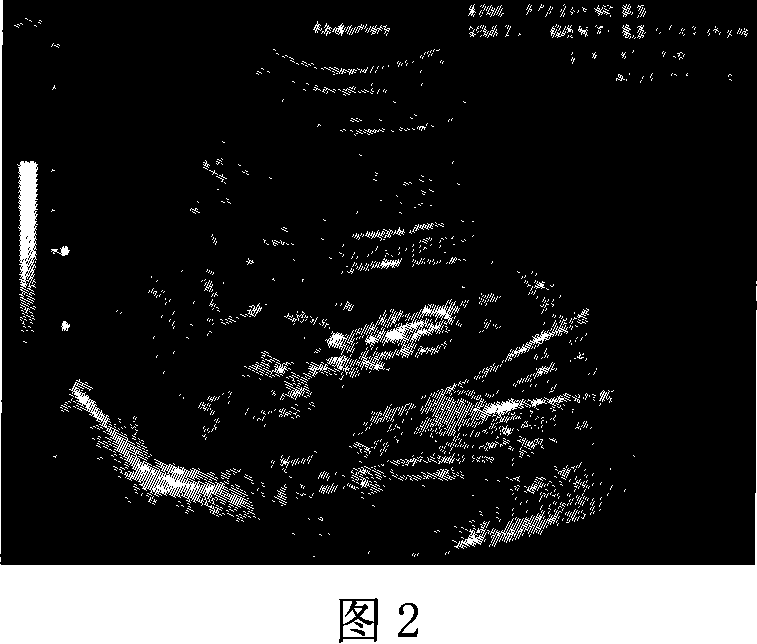 Medical ultrasonic image compression method based on the mixed wavelet coding