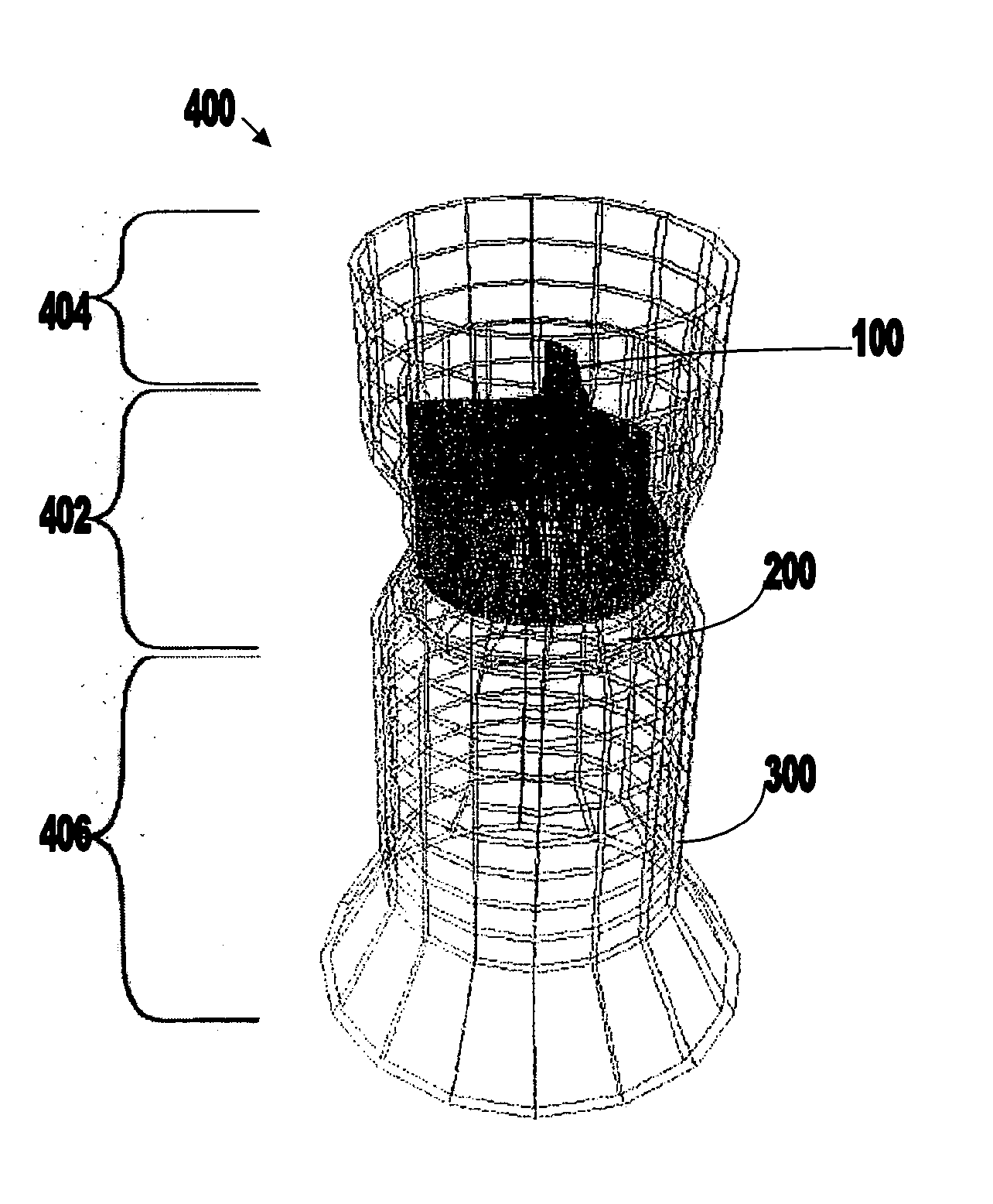 Stent-valves for valve replacement and associated methods and systems for surgery