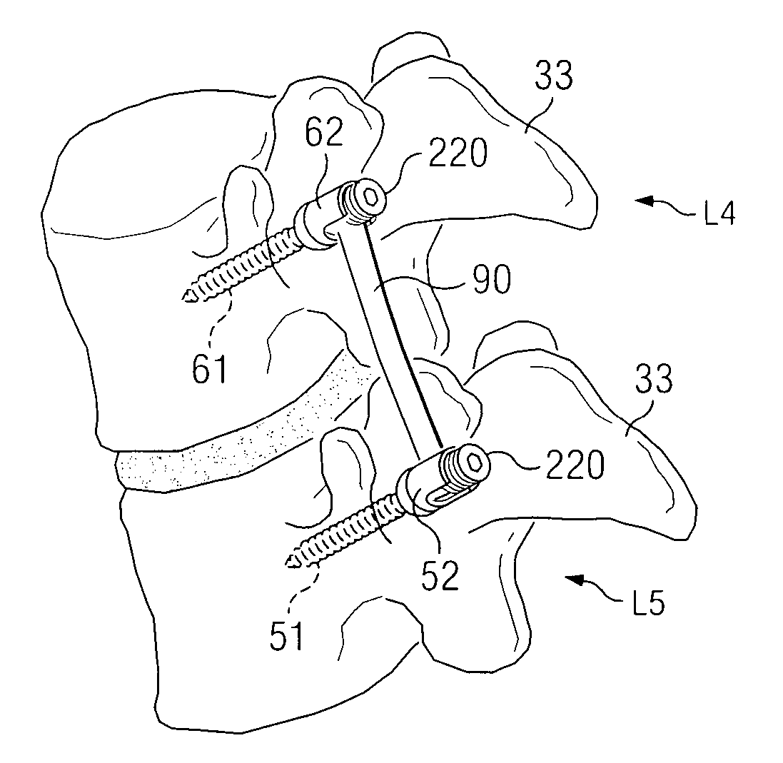 System and method for stabilizing of internal structures