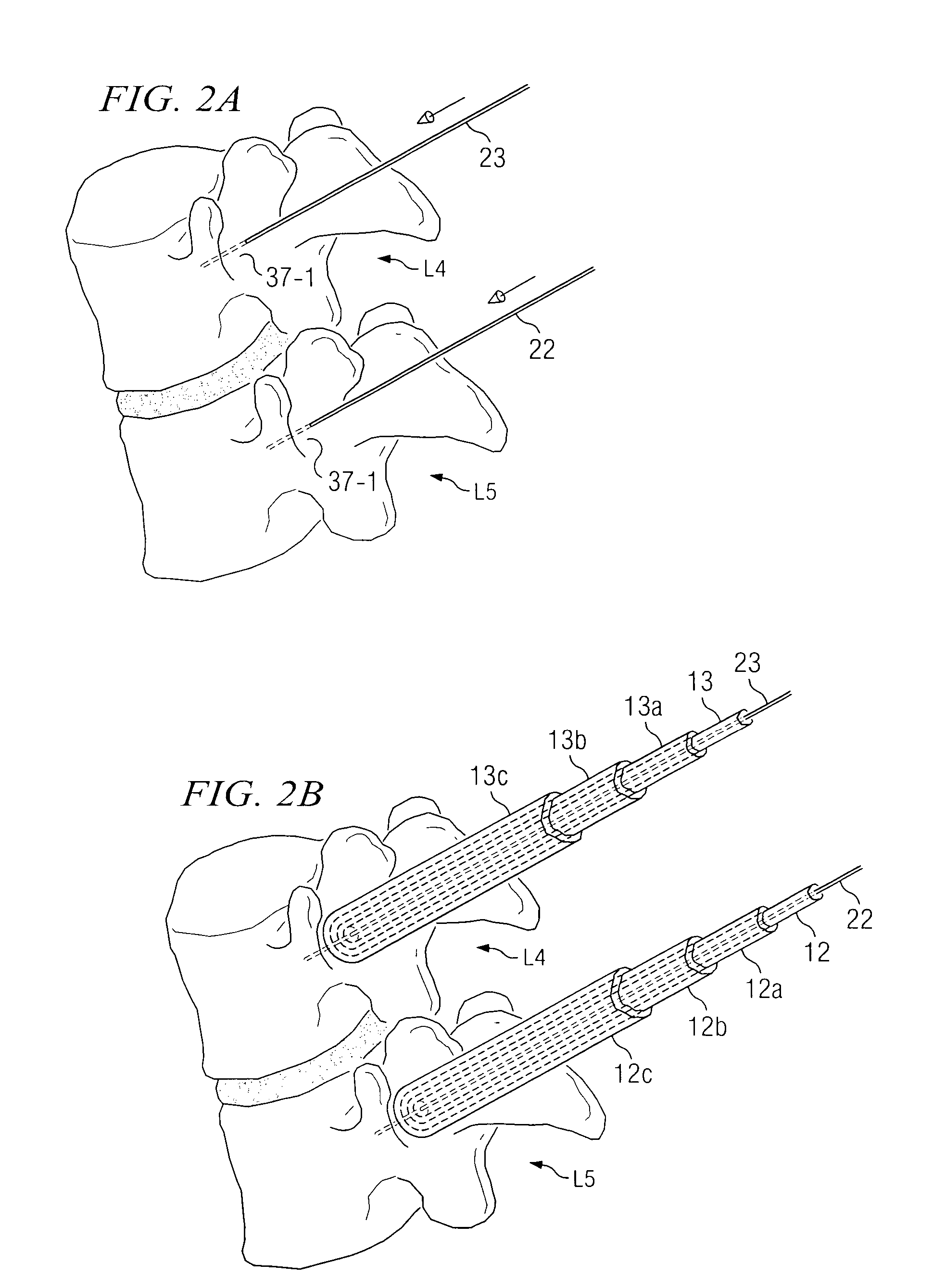System and method for stabilizing of internal structures