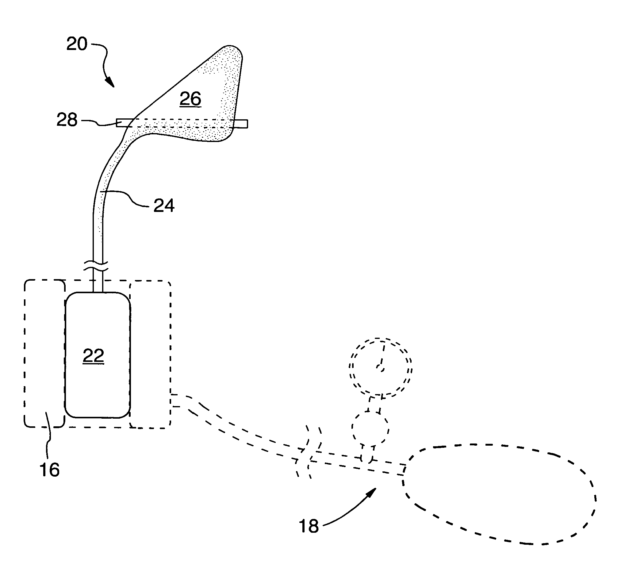 Epistaxis apparatus and method