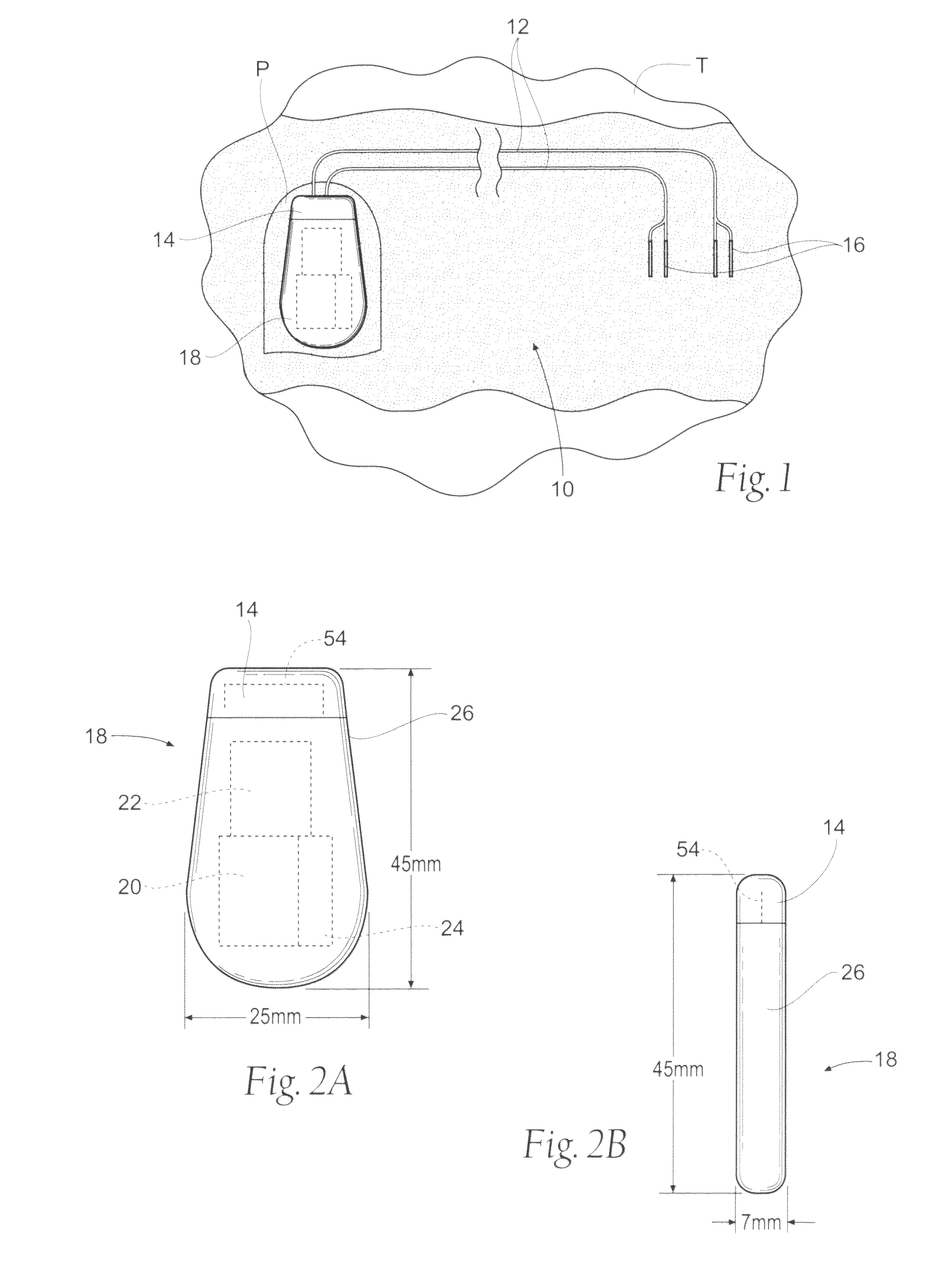 Implantable systems and methods for acquisition and processing of electrical signals