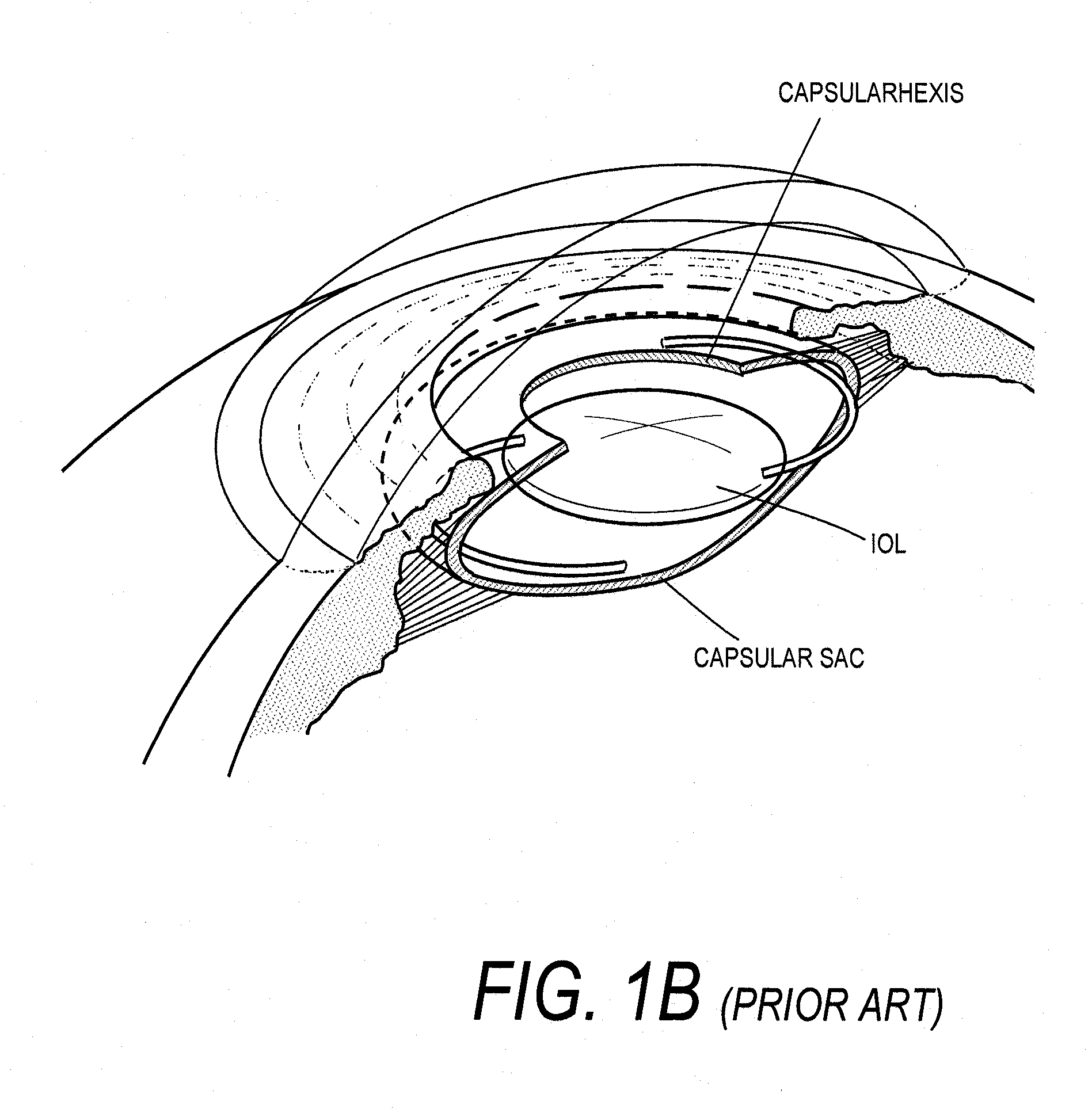 Intraocular Lenses and Business Methods