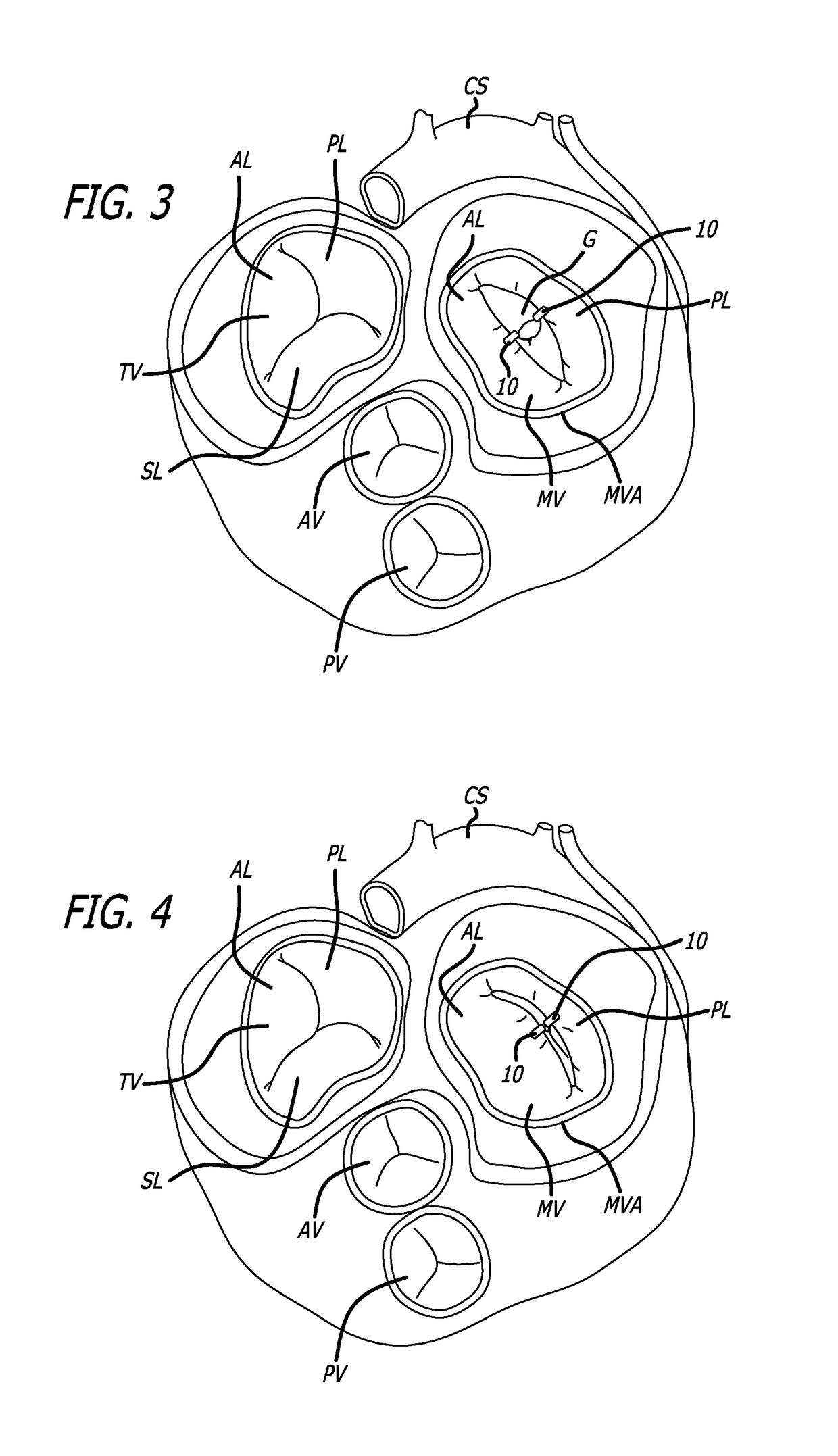 Fixation devices, systems and methods for heart valve leaf repair